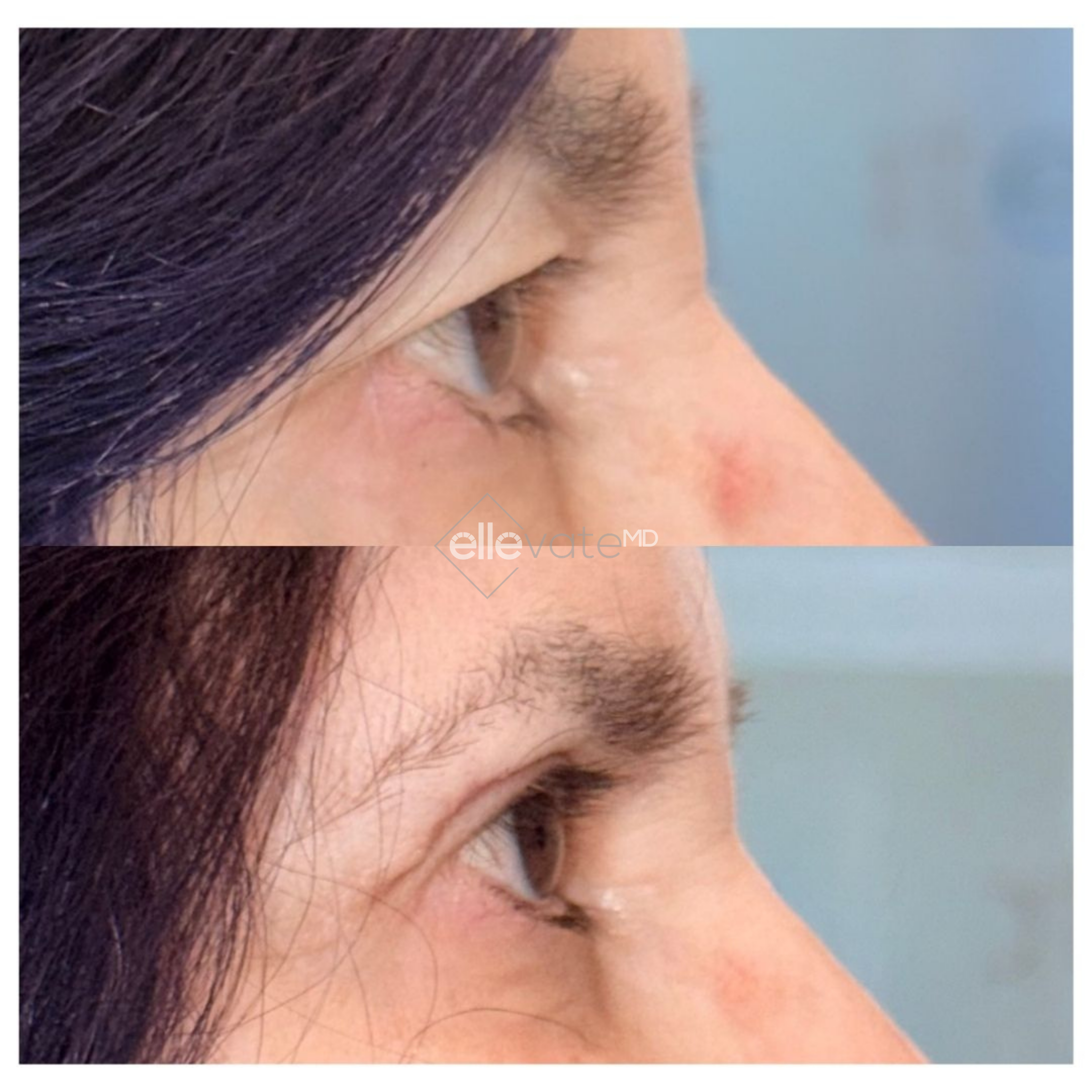 Before and after side profile comparison showing improved jawline and neck definition