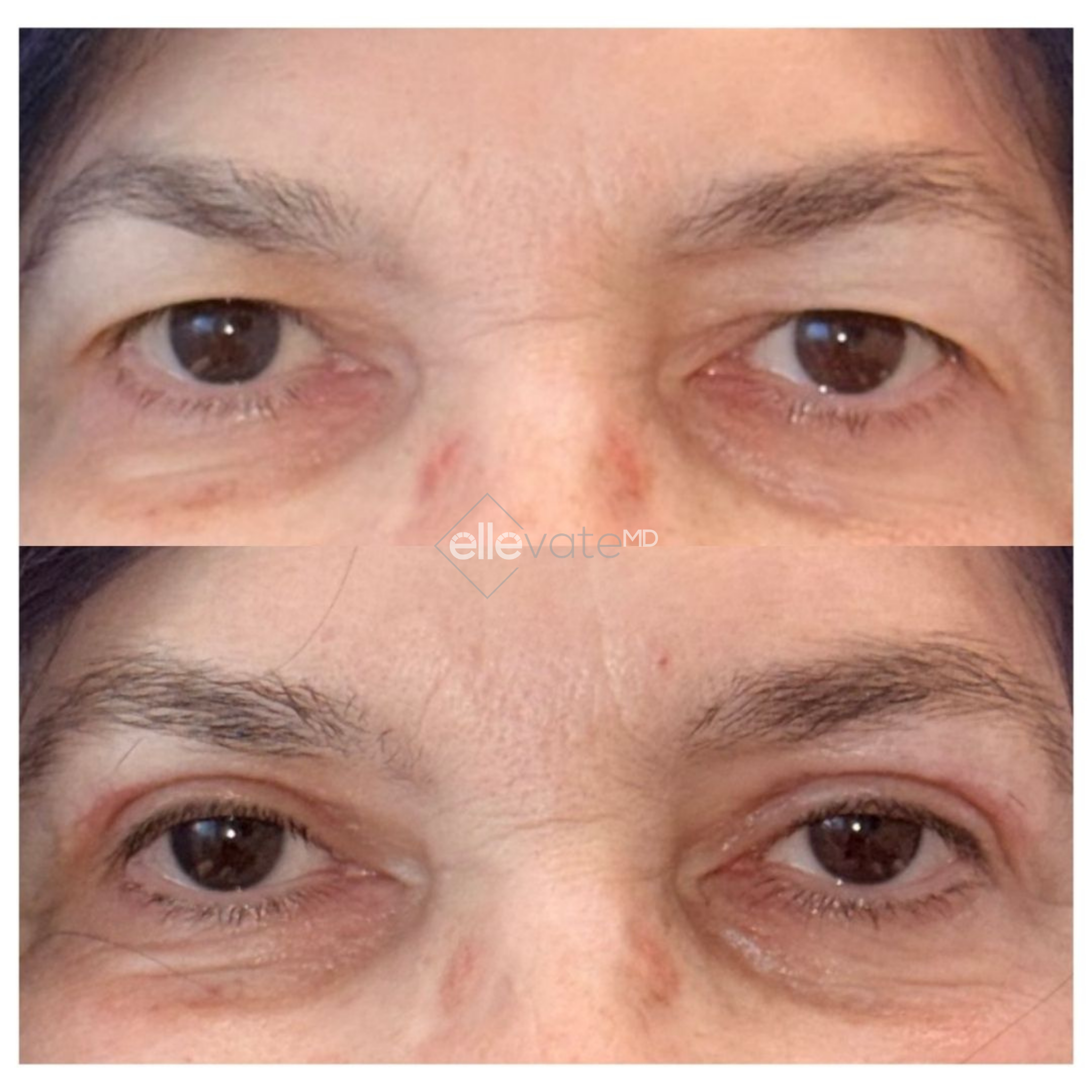Before and after Signature Lift 230 treatment showing reduced under-eye hollowing and improved skin texture