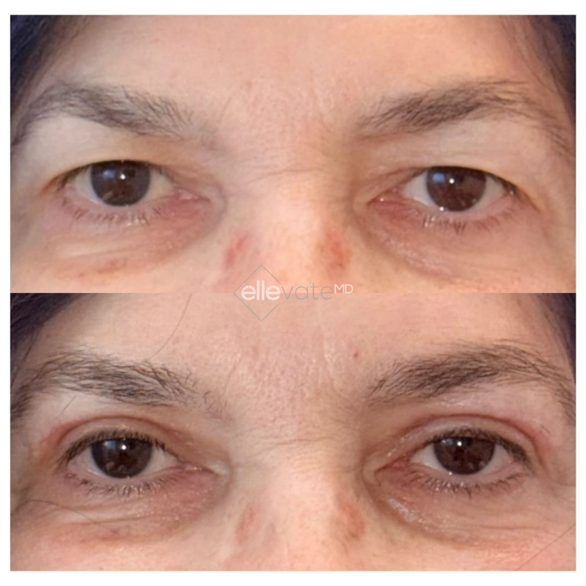 Before and after Signature Lift 230 treatment showing reduced under-eye hollowing and improved skin texture