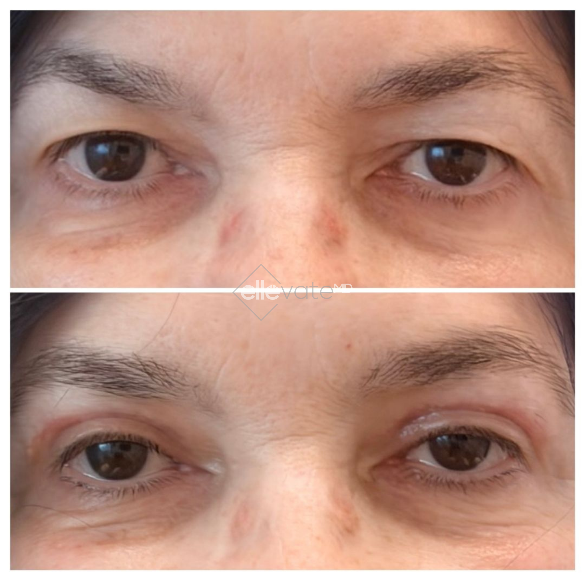 Before and after Signature Lift 230 showing improved eye area definition and reduced wrinkles