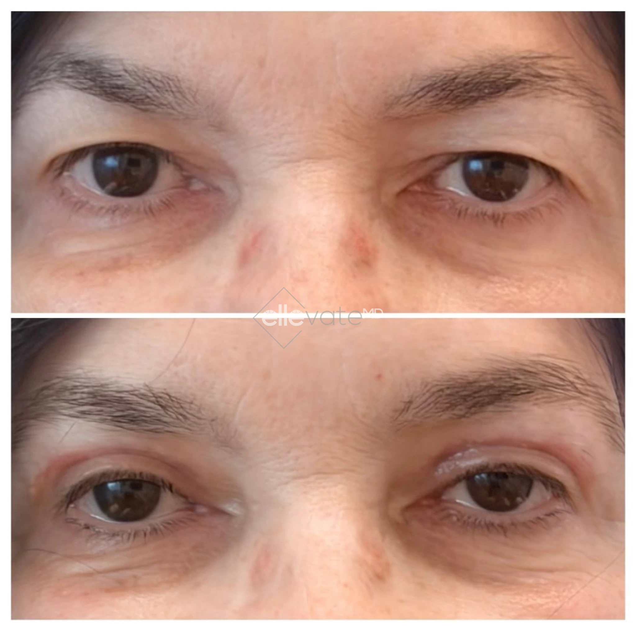 Before and after Signature Lift 230 showing improved eye area definition and reduced wrinkles