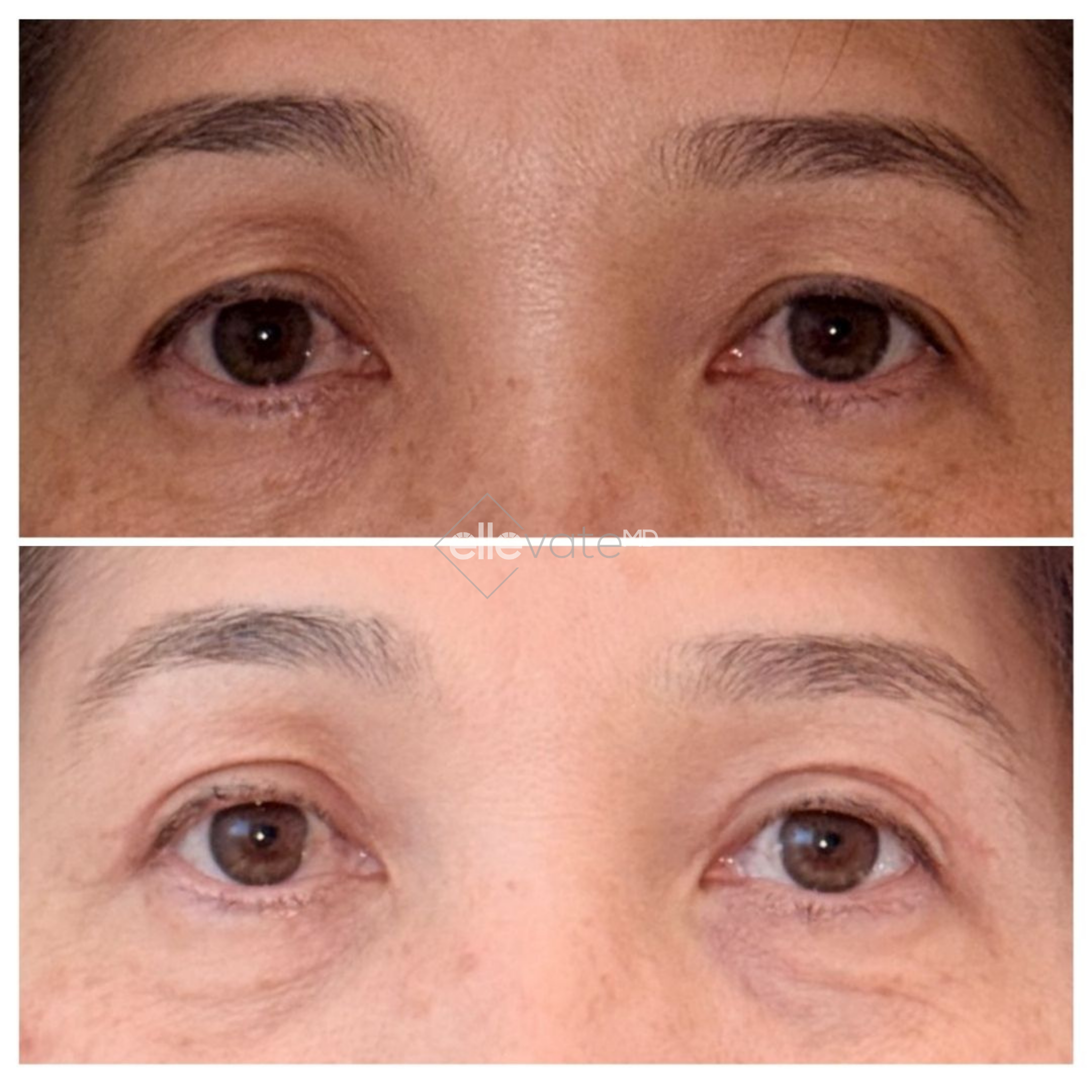 Before and after Signature Lift 231 demonstrating lifted eyelid appearance and diminished fine lines