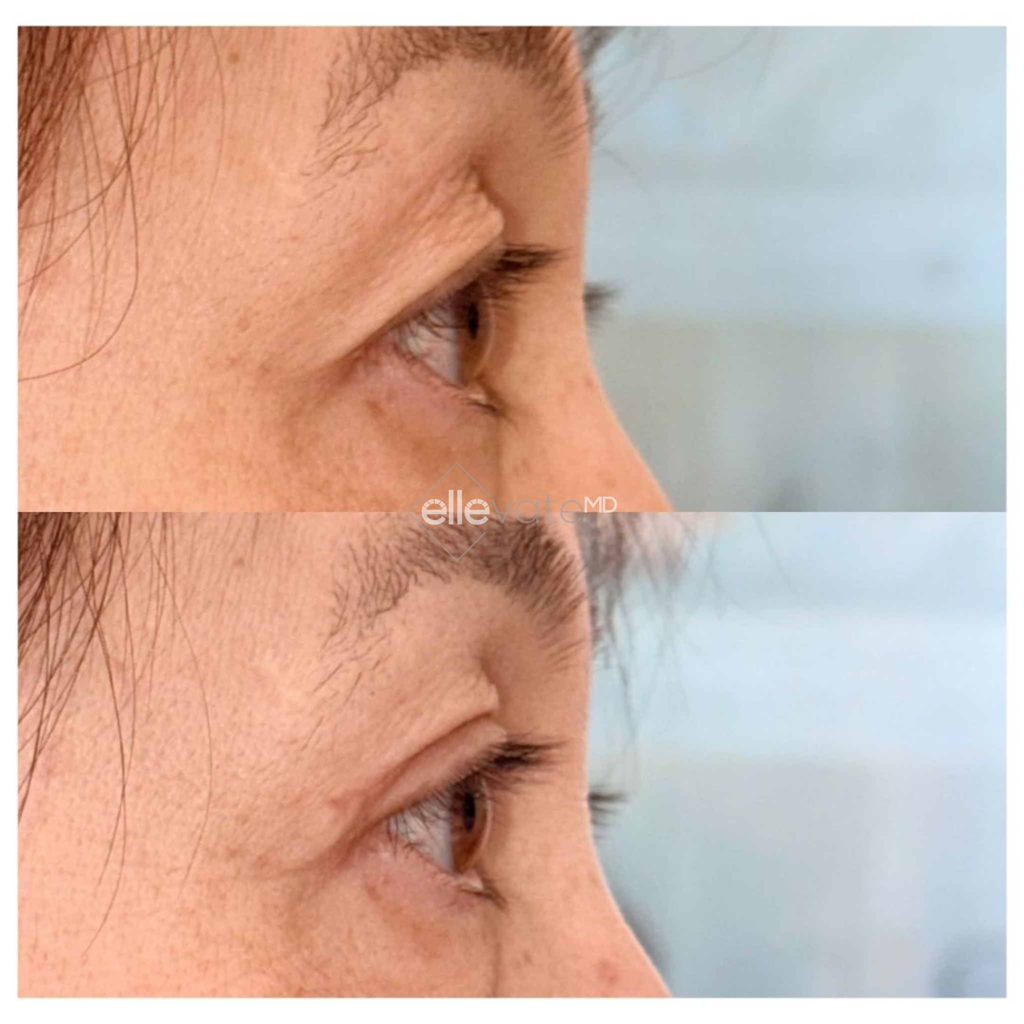 Before and after Signature Lift 231 profile view showing improved orbital area definition and lift