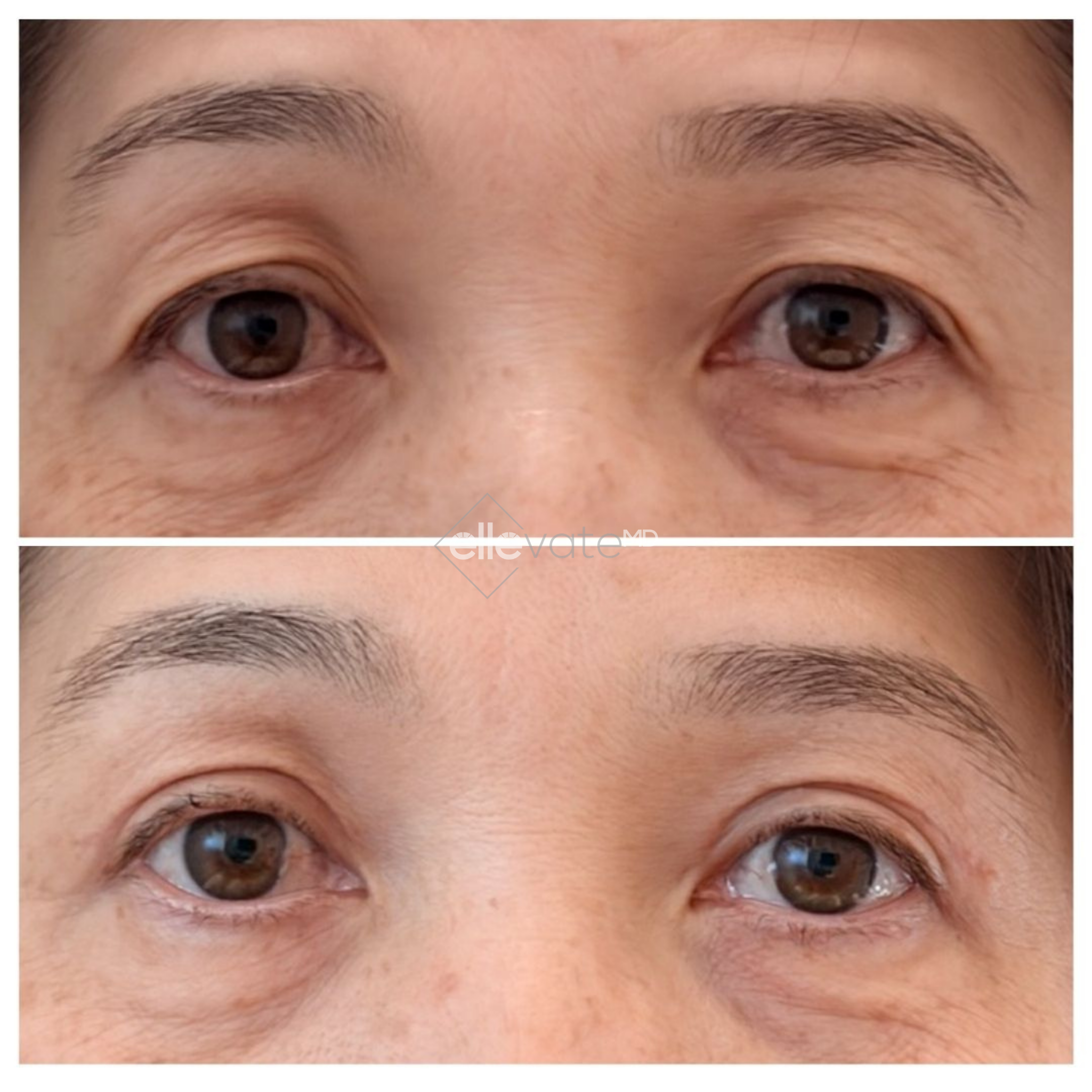 Before and after eye area treatment showing reduced crow's feet and improved skin firmness