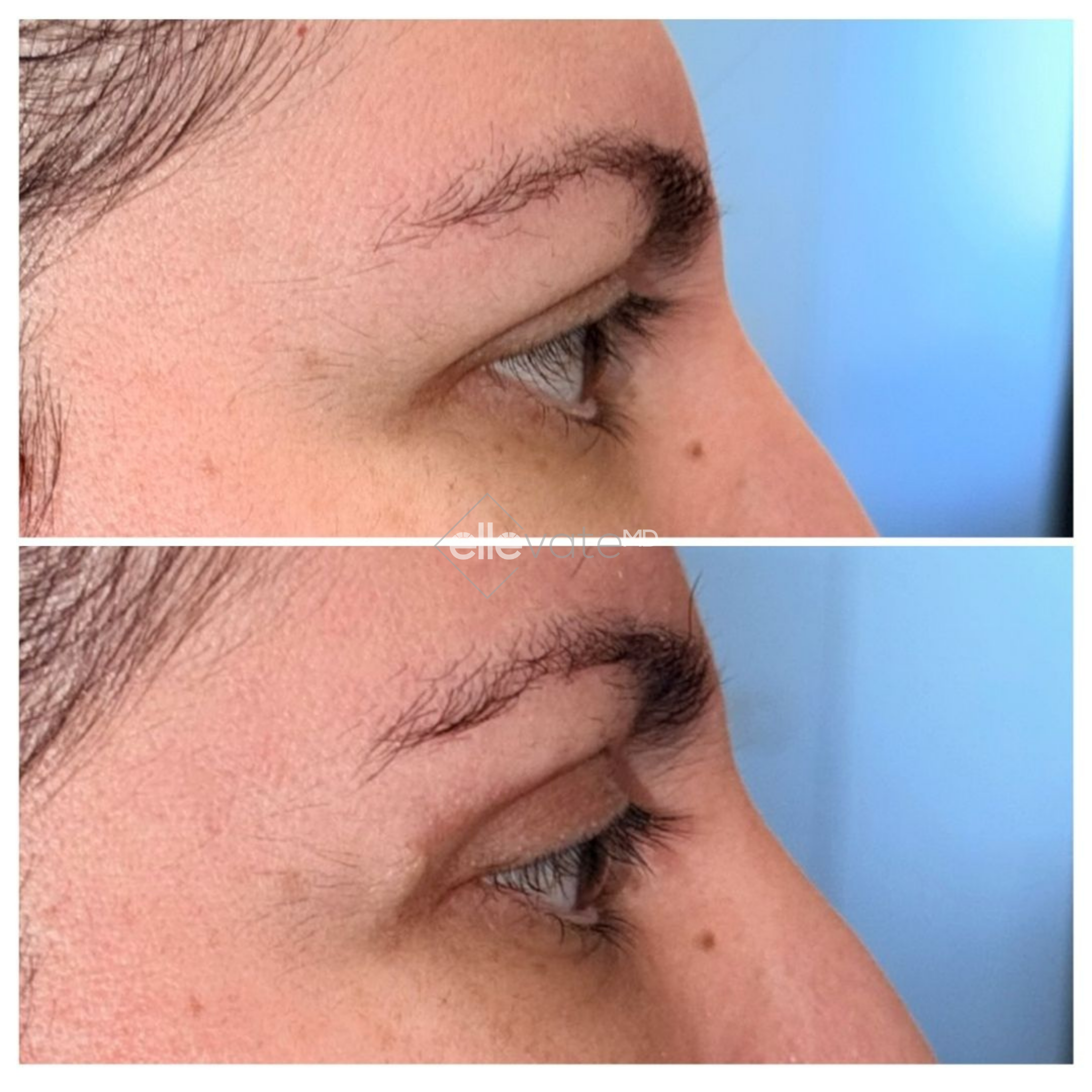 Before and after Signature Lift 232 profile view showing enhanced eye contour and reduced lateral wrinkles