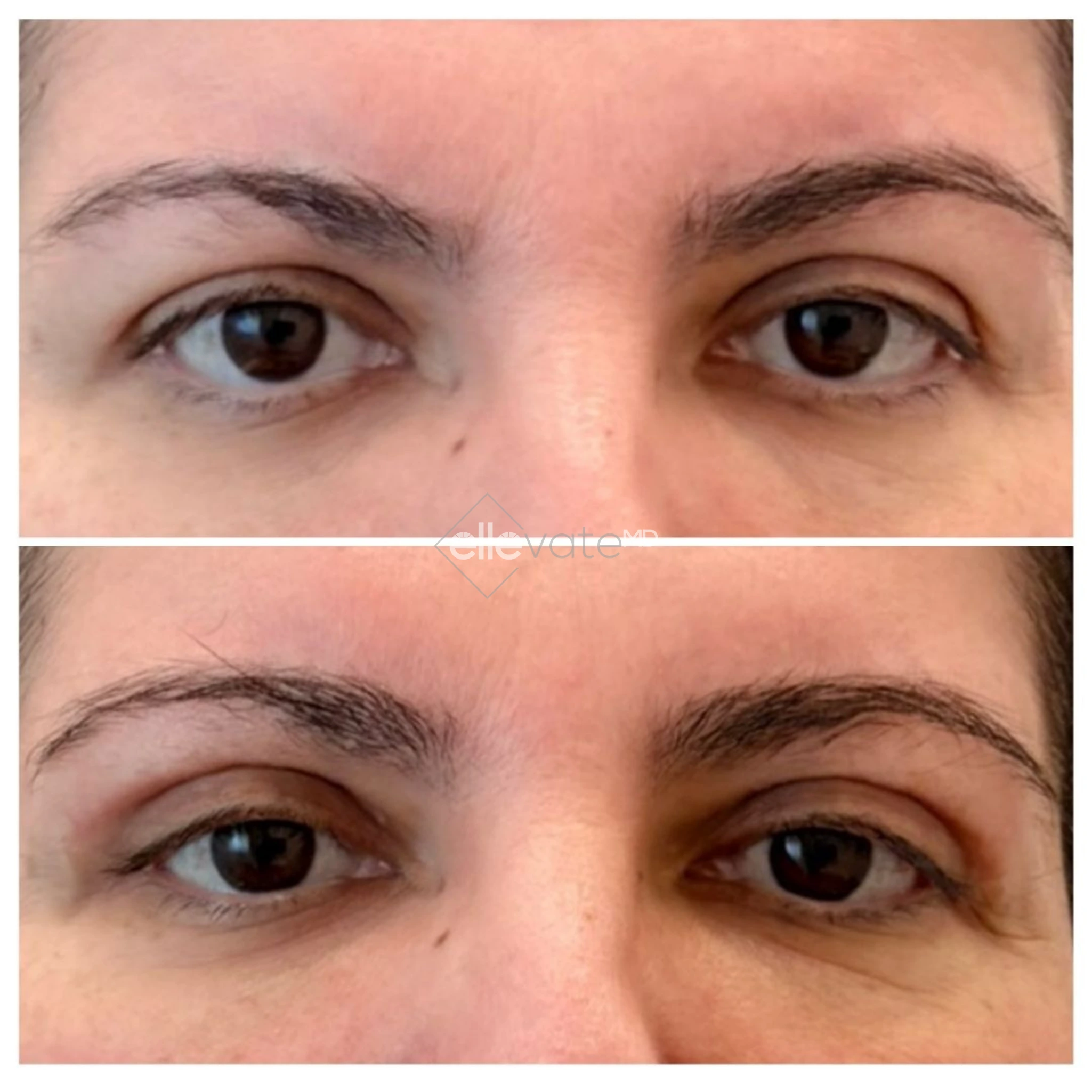Before and after comparison of eyes showing reduced under-eye hollowing and improved eye area definition with Signature Lift treatment