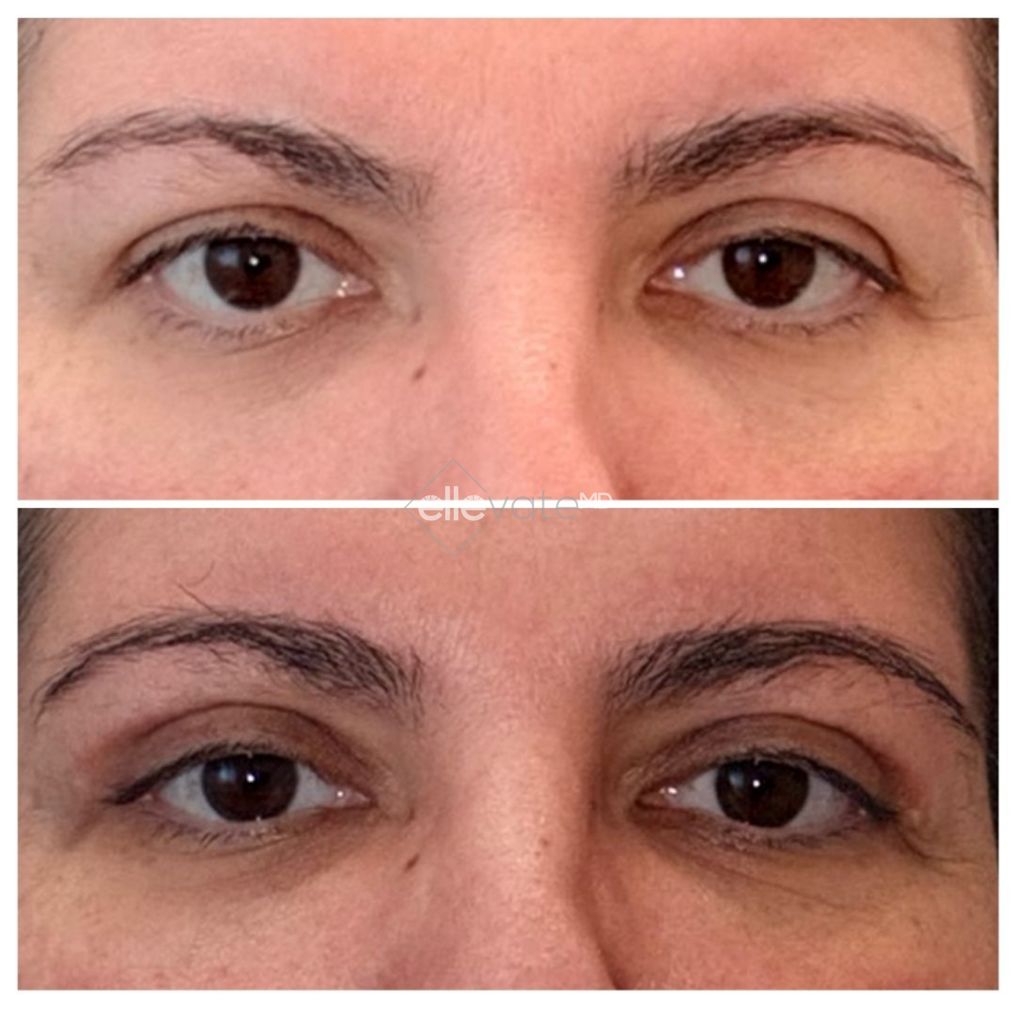 Before and after comparison of eyes showing improved eye contour and reduced tired appearance with Signature Lift treatment