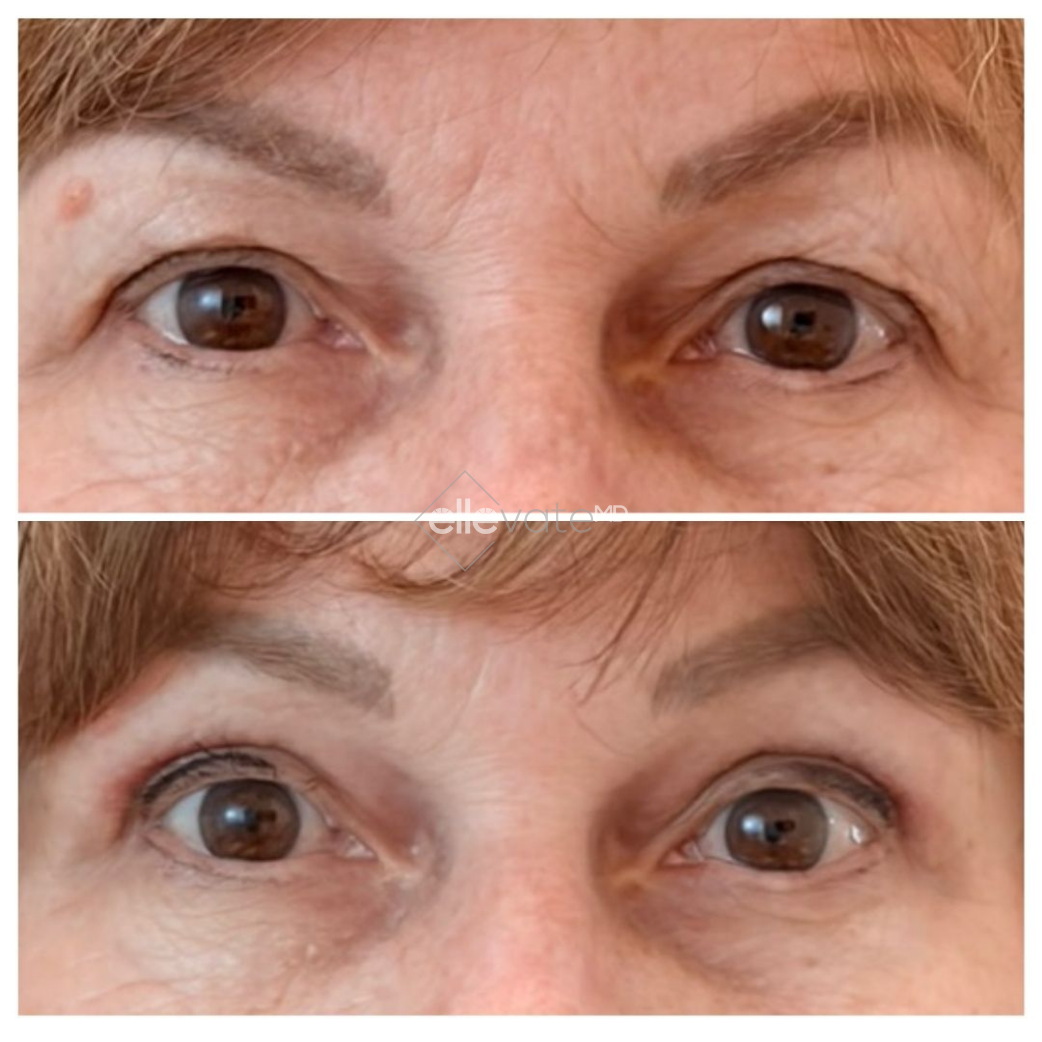 Before and after comparison of eyes showing reduced wrinkles and improved skin quality around eye area with Signature Lift treatment