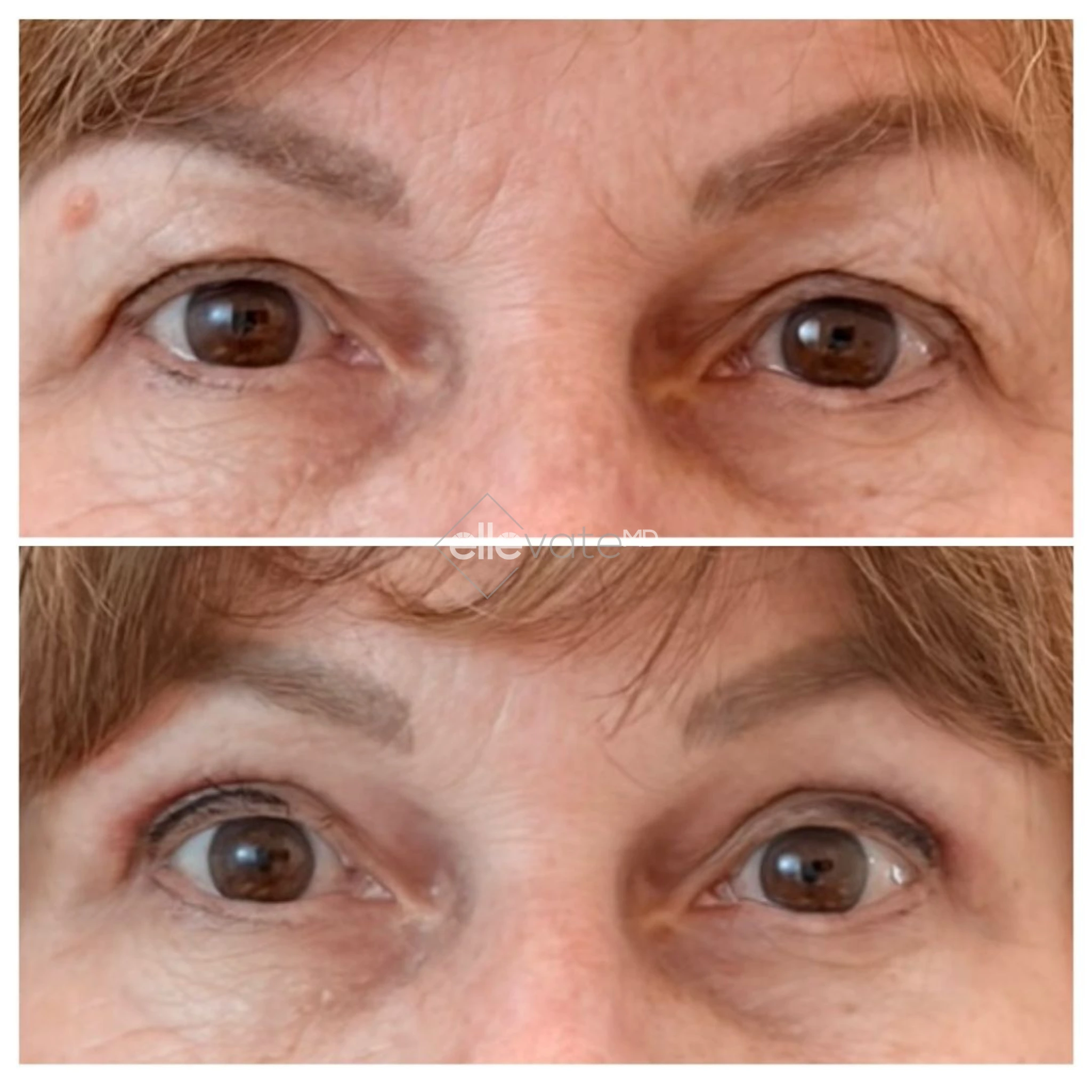 Before and after comparison of eyes showing reduced wrinkles and improved skin quality around eye area with Signature Lift treatment