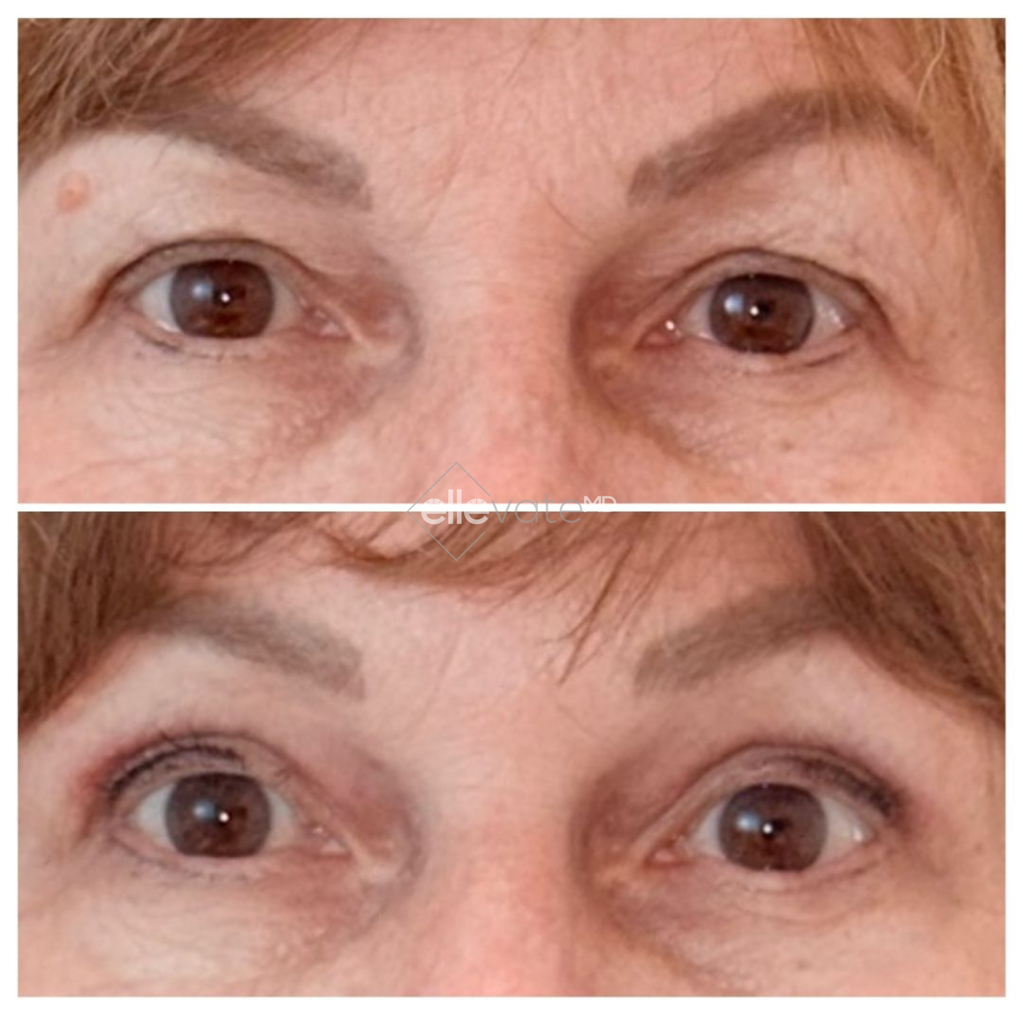 Before and after comparison of eyes showing decreased crow's feet and improved eye area smoothness with Signature Lift treatment