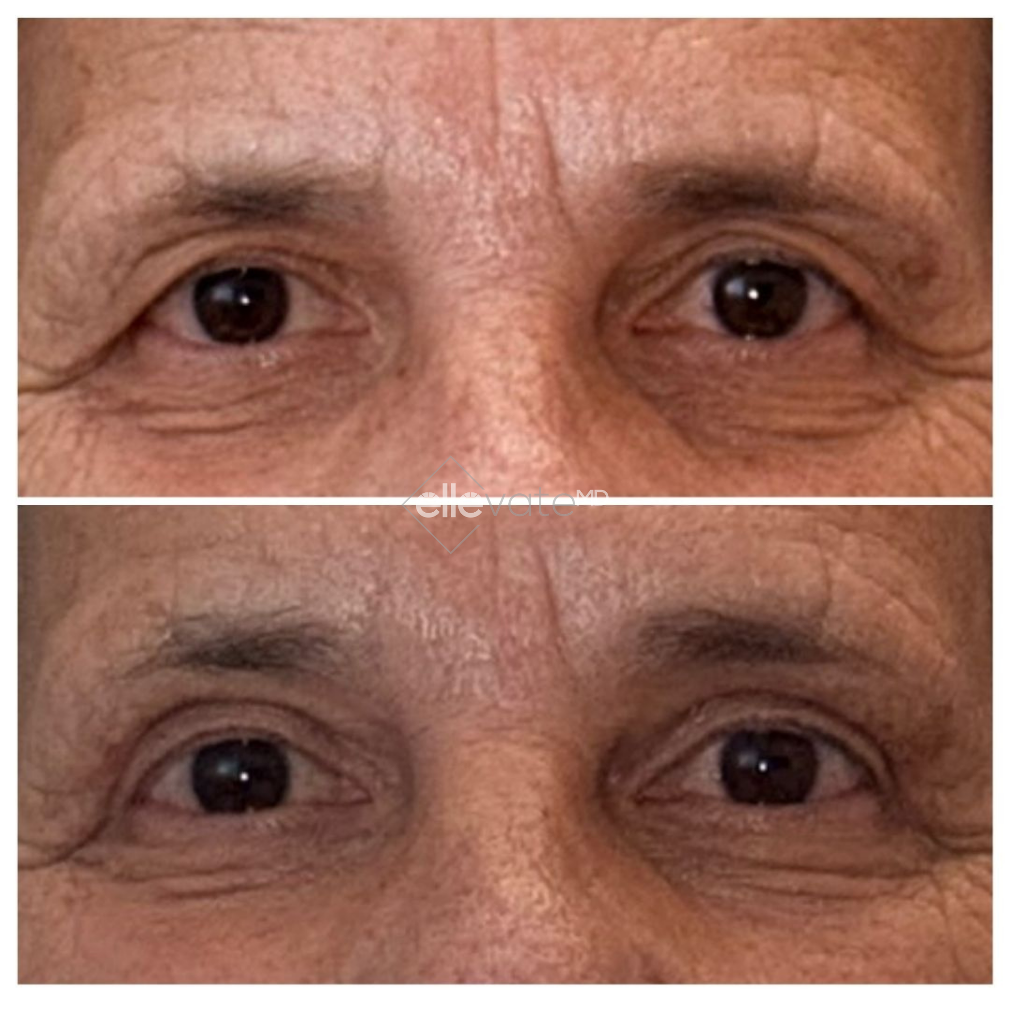 Before and after comparison of eyes showing reduced deep wrinkles and improved skin texture around eyes with Signature Lift treatment