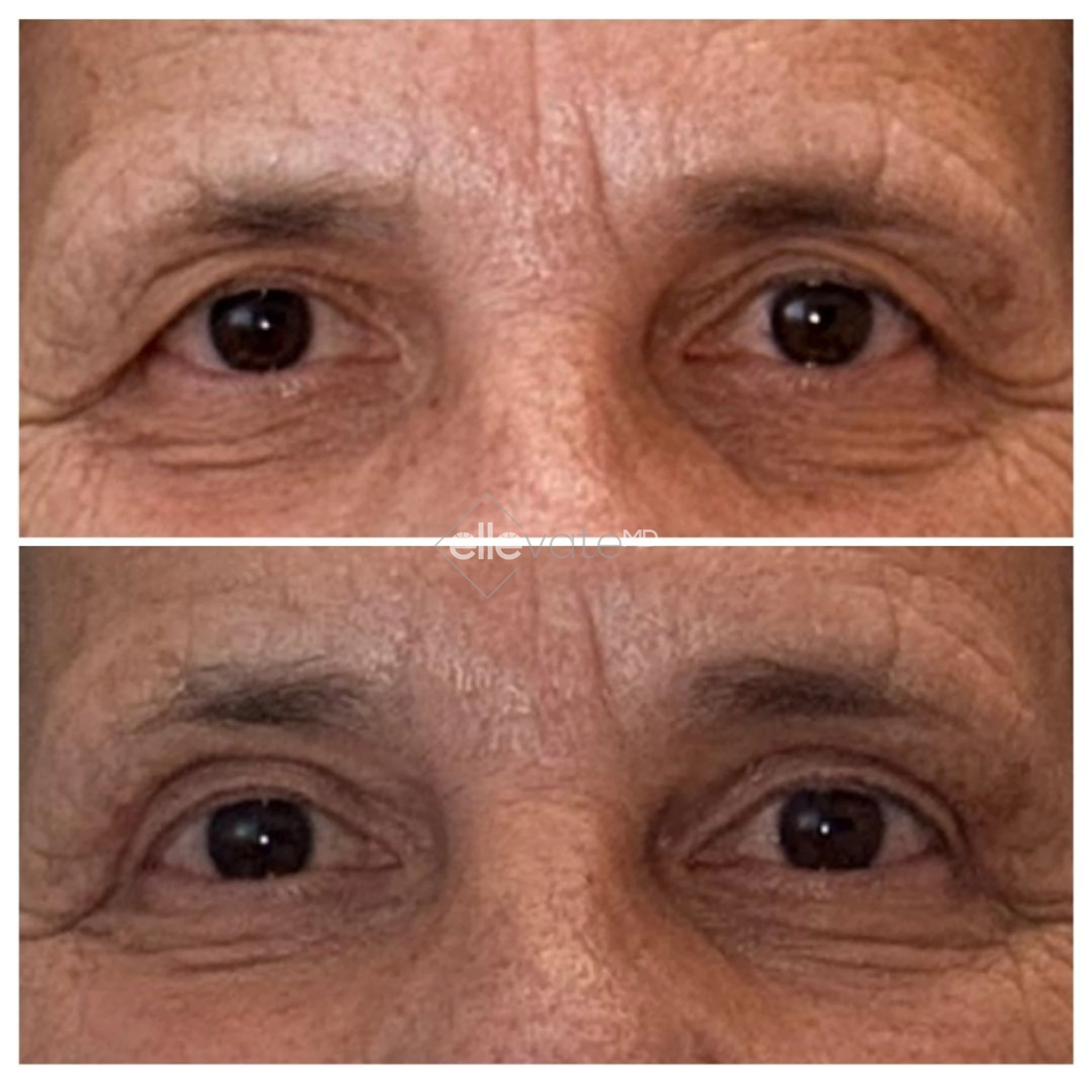 Before and after comparison of eyes showing reduced deep wrinkles and improved skin texture around eyes with Signature Lift treatment
