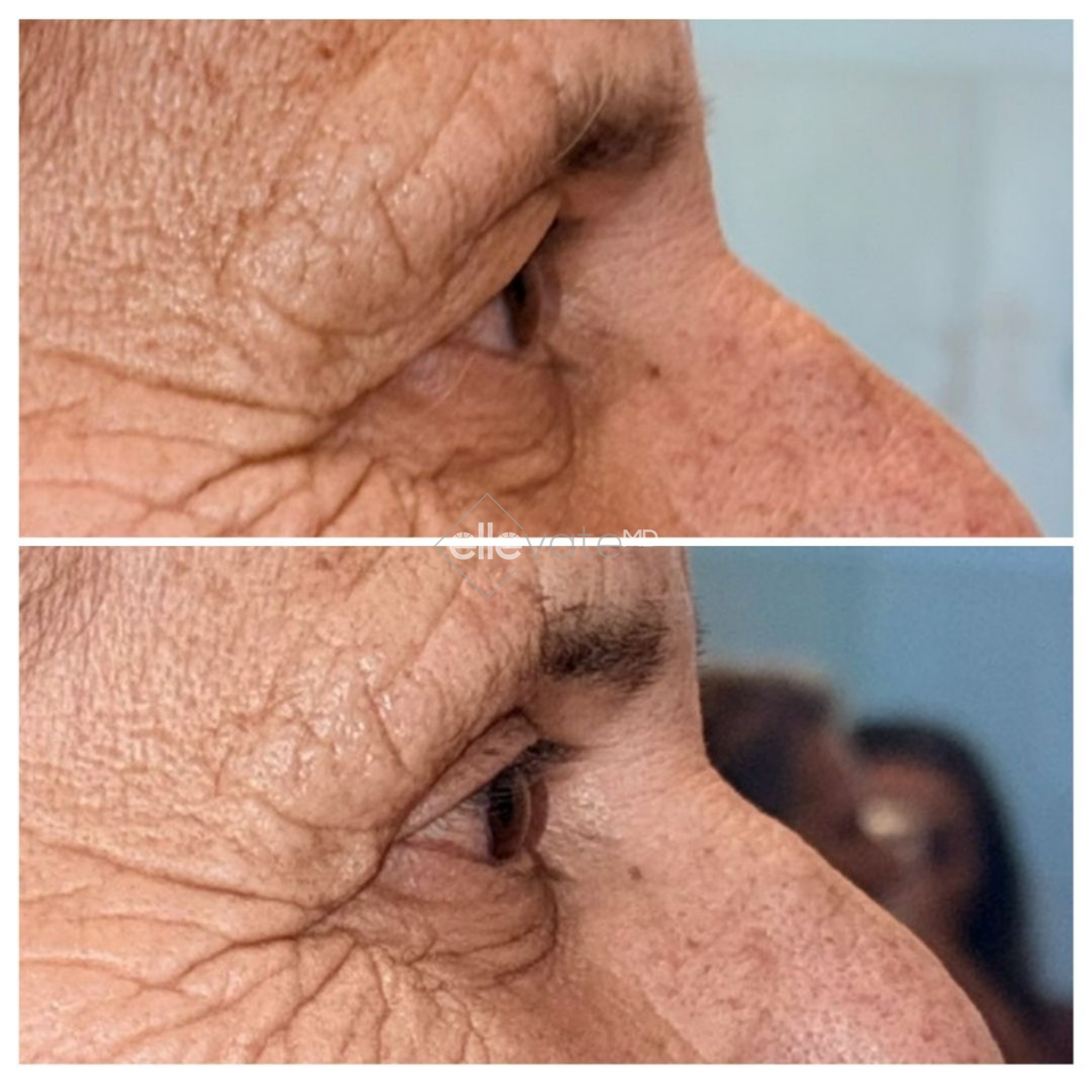 Before and after side profile showing improved neck and jawline definition with Signature Lift treatment