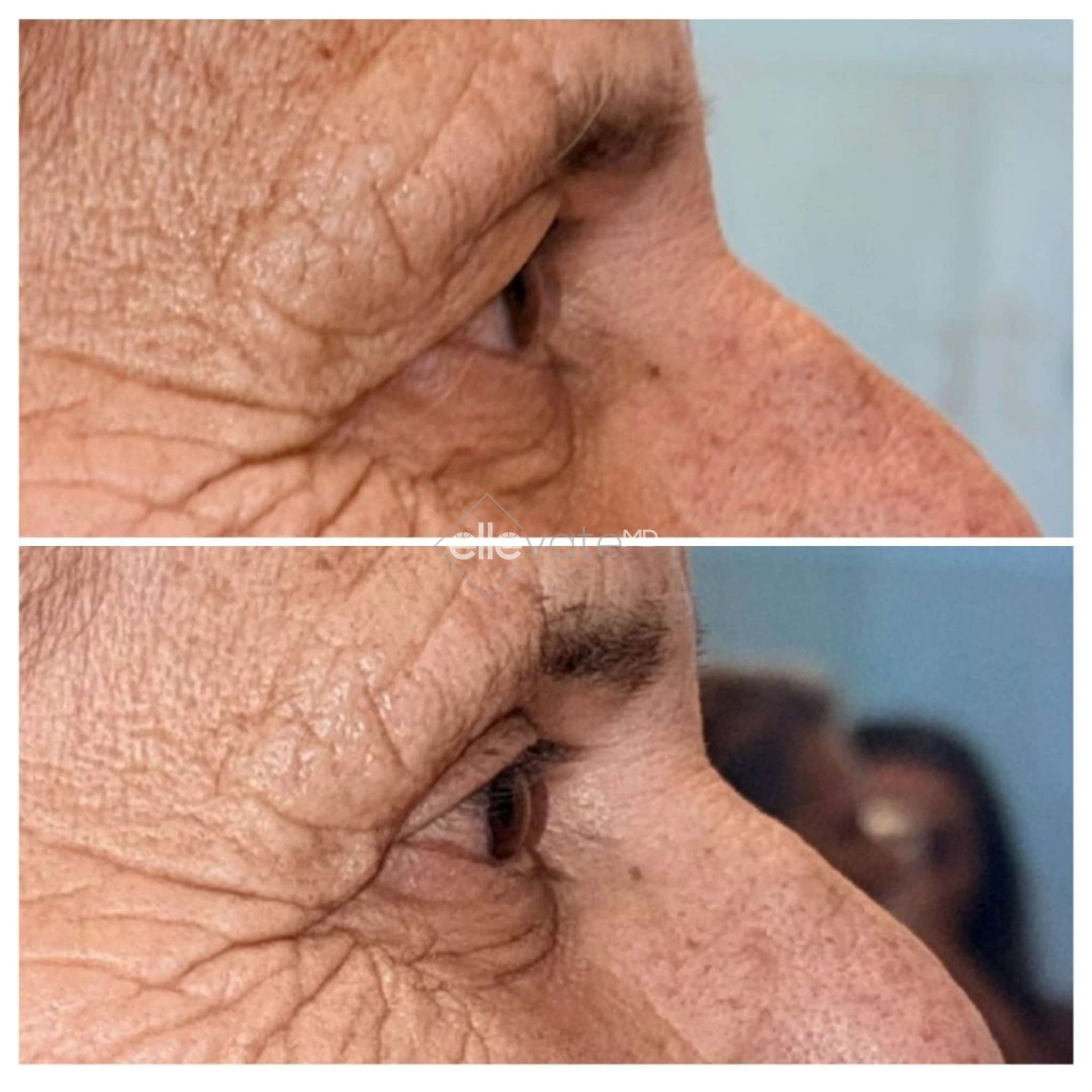 Before and after side profile showing improved neck and jawline definition with Signature Lift treatment