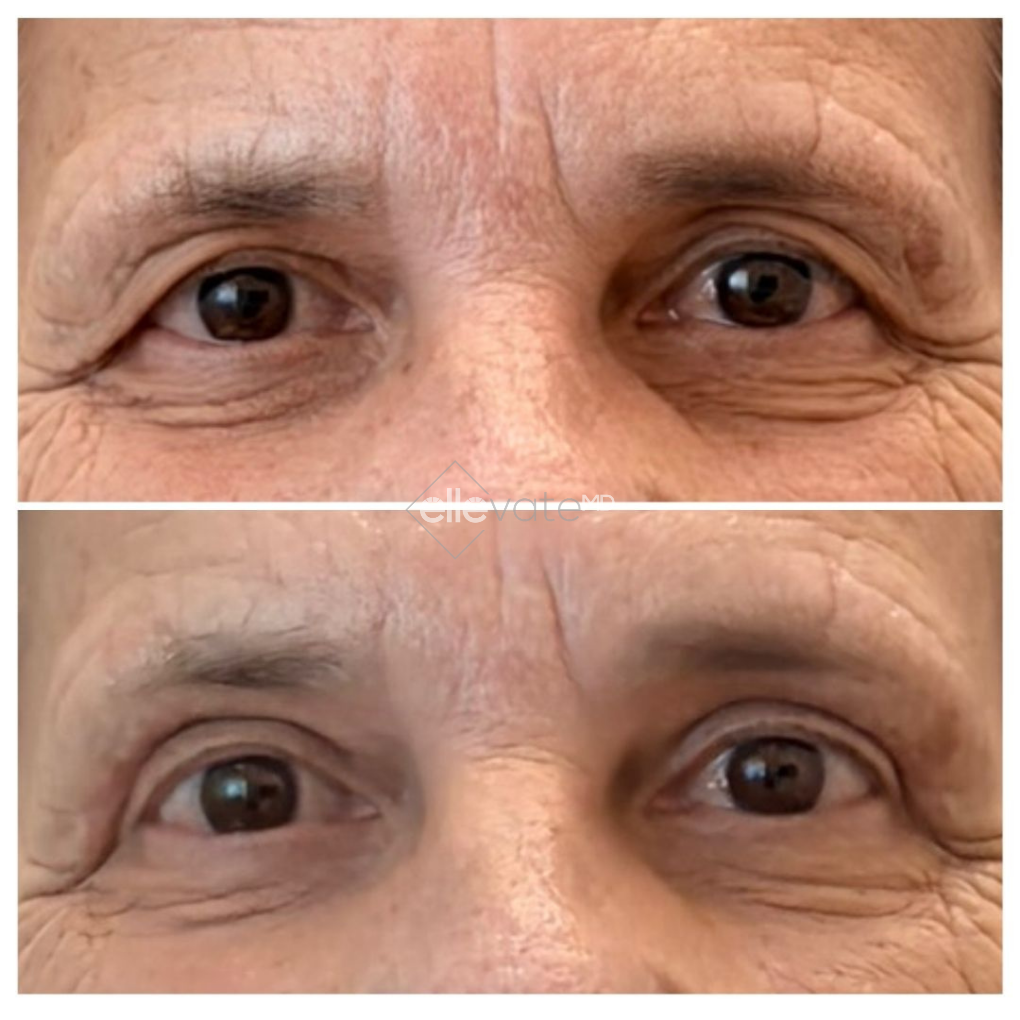 Before and after Signature Lift treatment showing reduced under-eye wrinkles and sagging skin