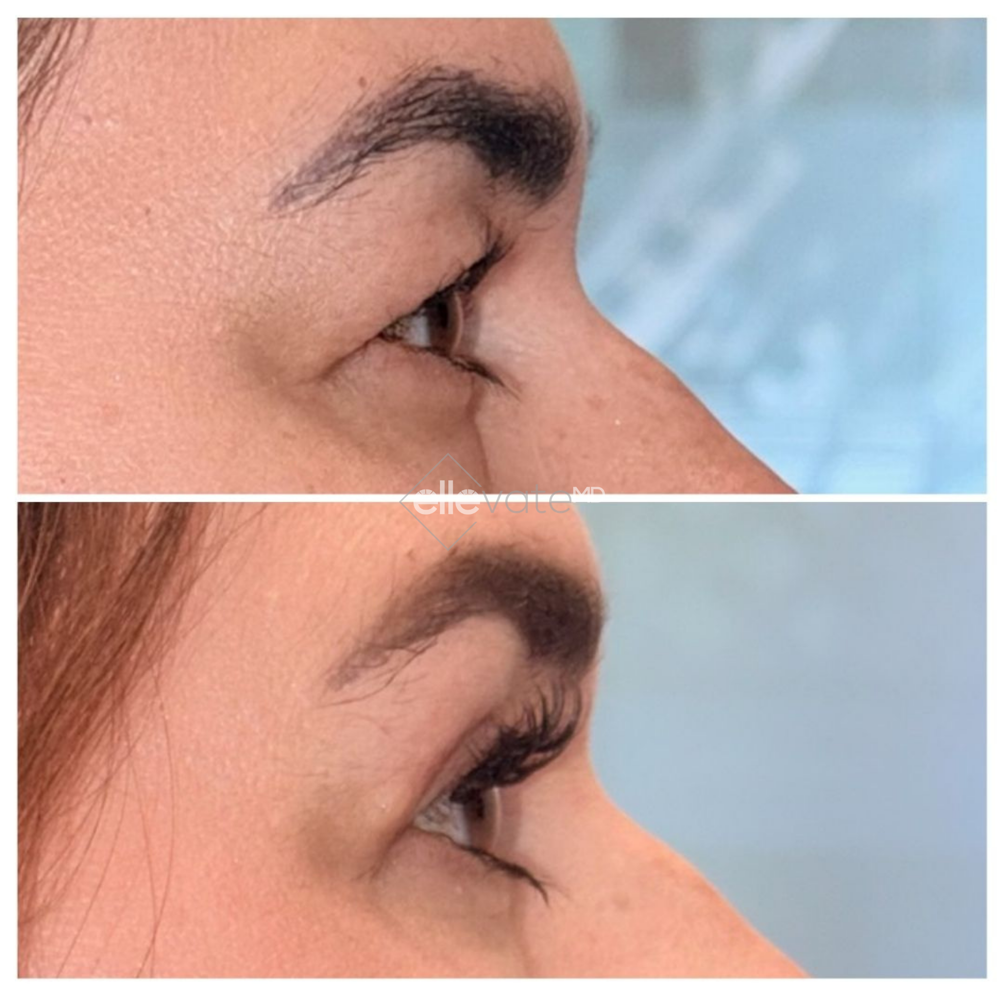 Before and after Signature Lift treatment showing improved neck and jawline definition in profile view