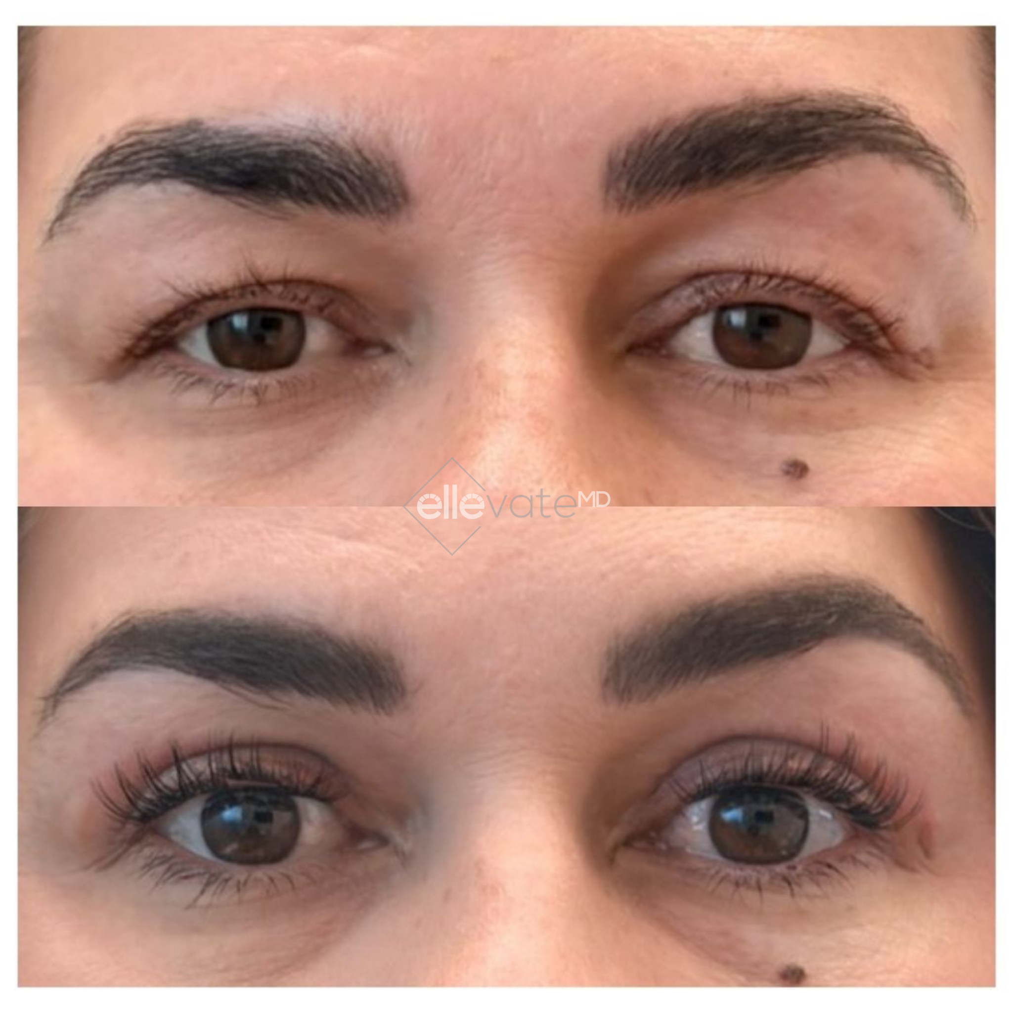 Before and after Signature Lift treatment showing reduced under-eye bags and improved eye area contour