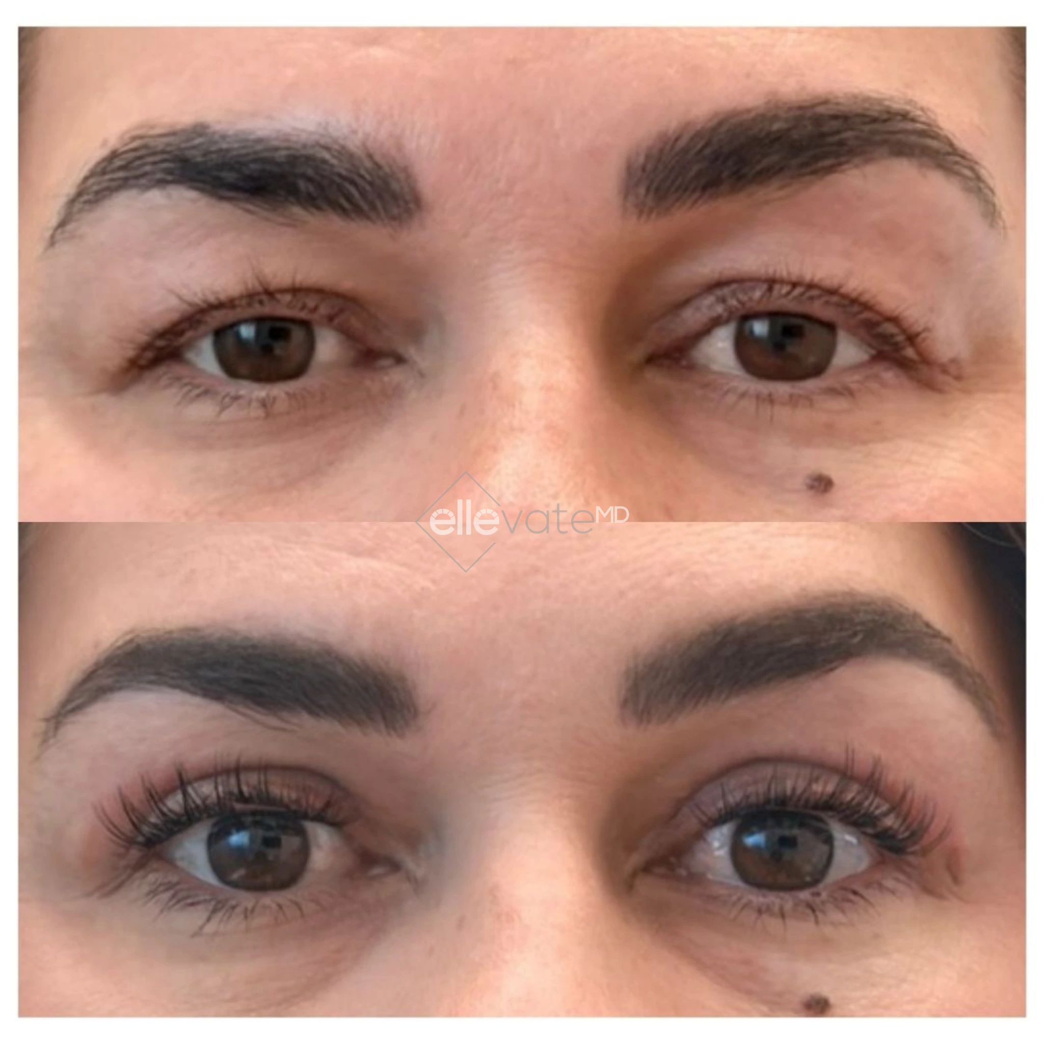 Before and after Signature Lift treatment showing reduced under-eye bags and improved eye area contour