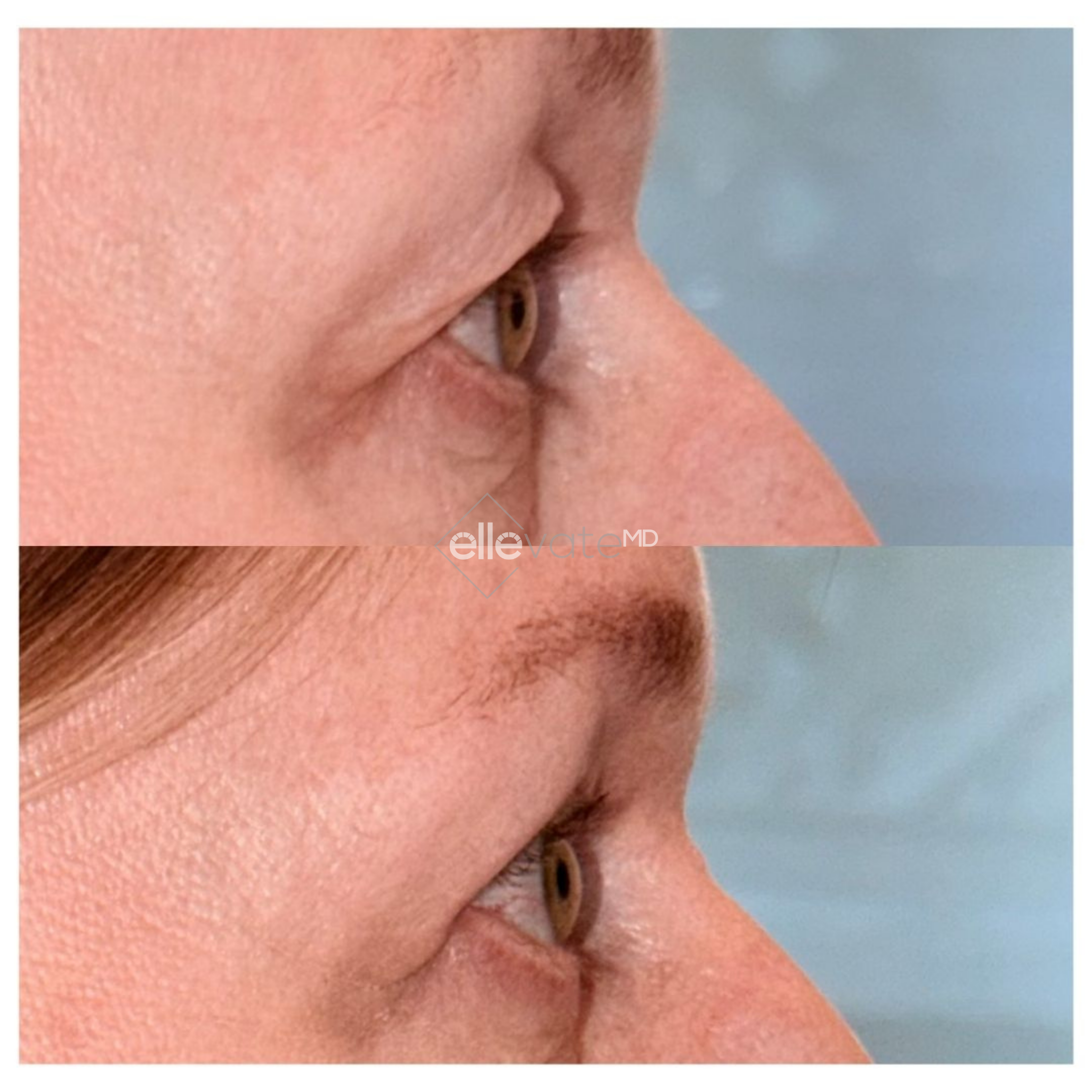 Before and after Signature Lift treatment showing improved neck texture and jawline tightness in profile