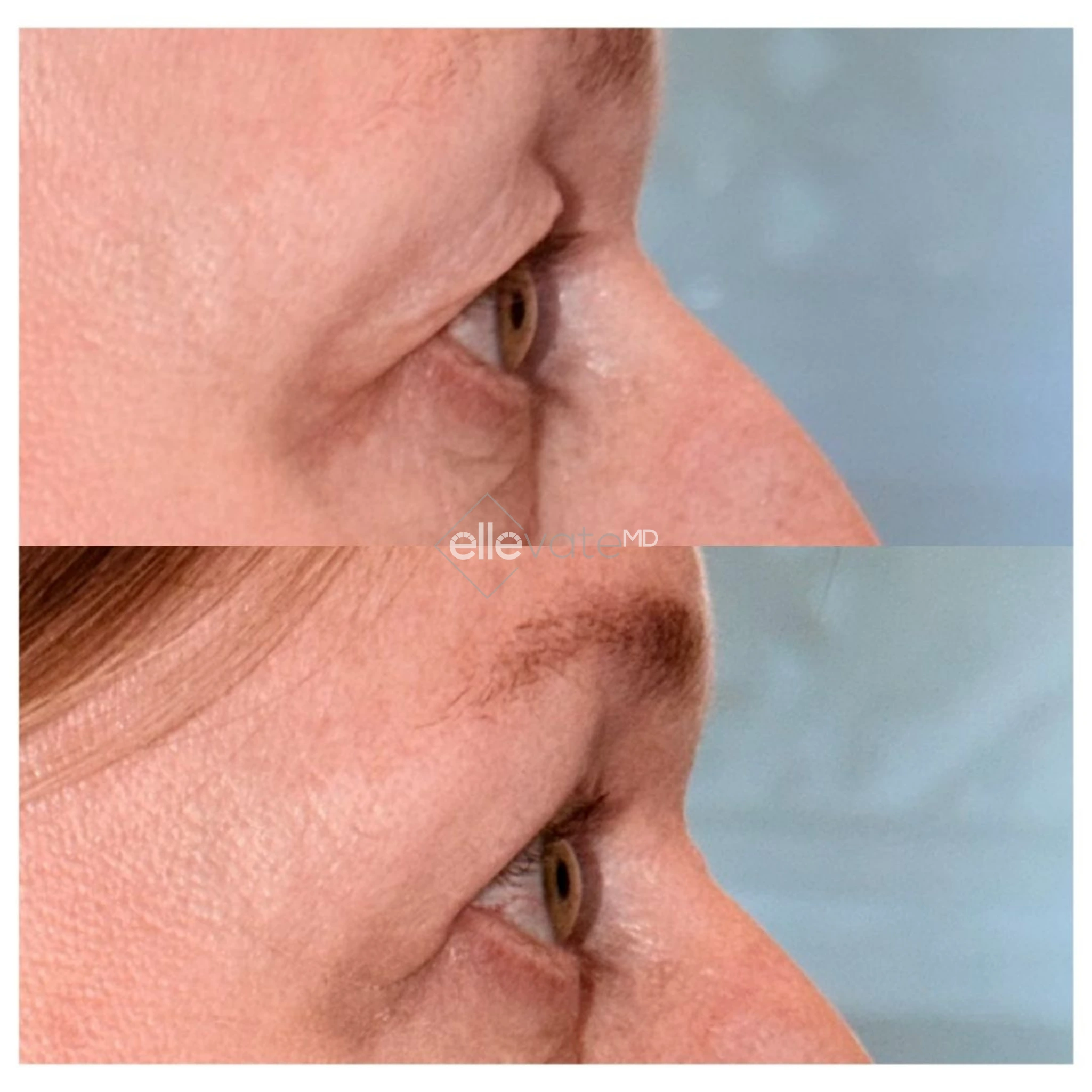 Before and after Signature Lift treatment showing improved neck texture and jawline tightness in profile