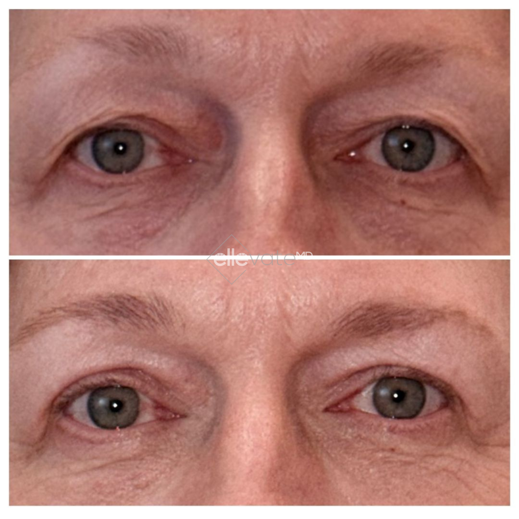 Before and after Signature Lift treatment showing reduced crow's feet and smoother periorbital area