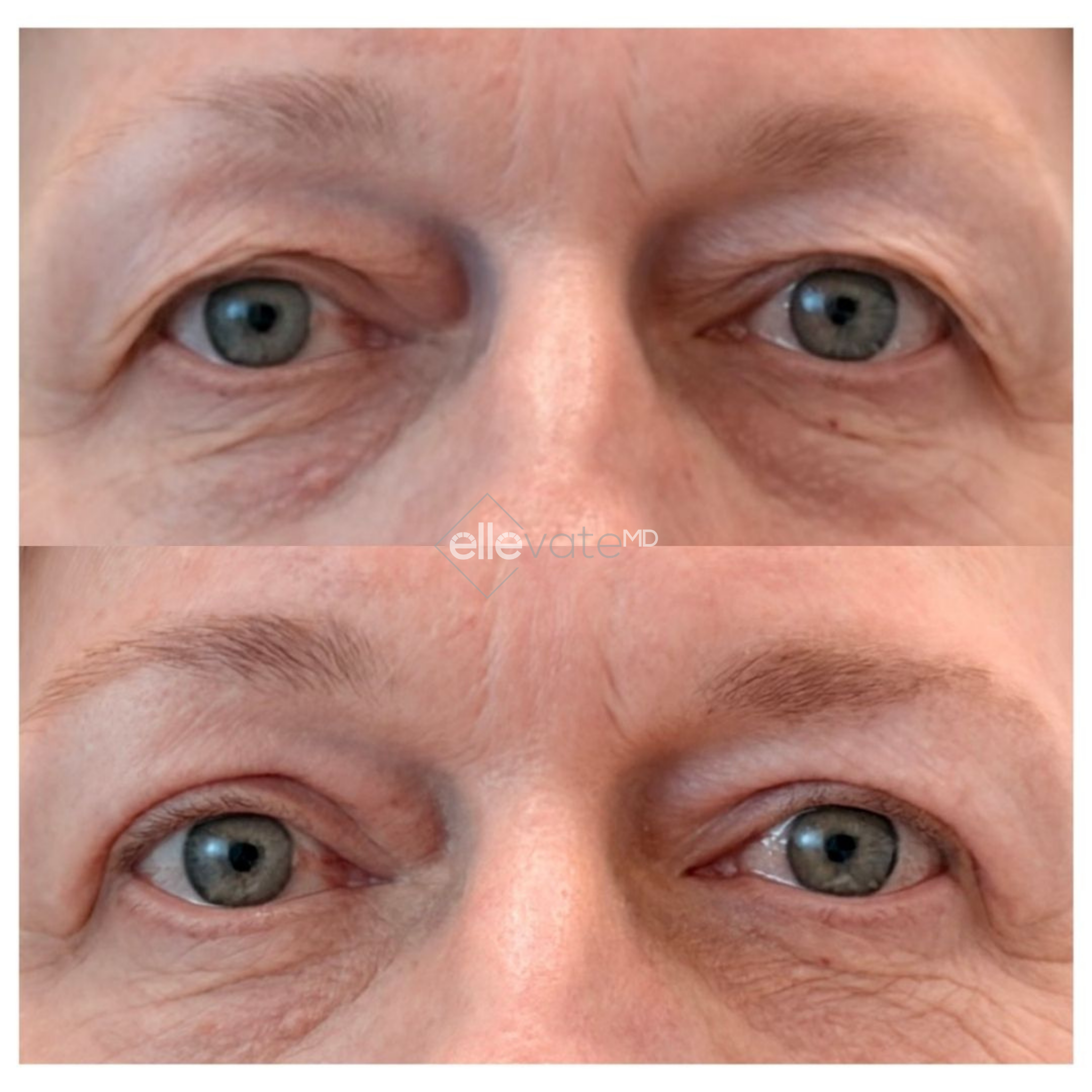 Before and after Signature Lift treatment showing reduced upper eyelid hooding and improved eye opening