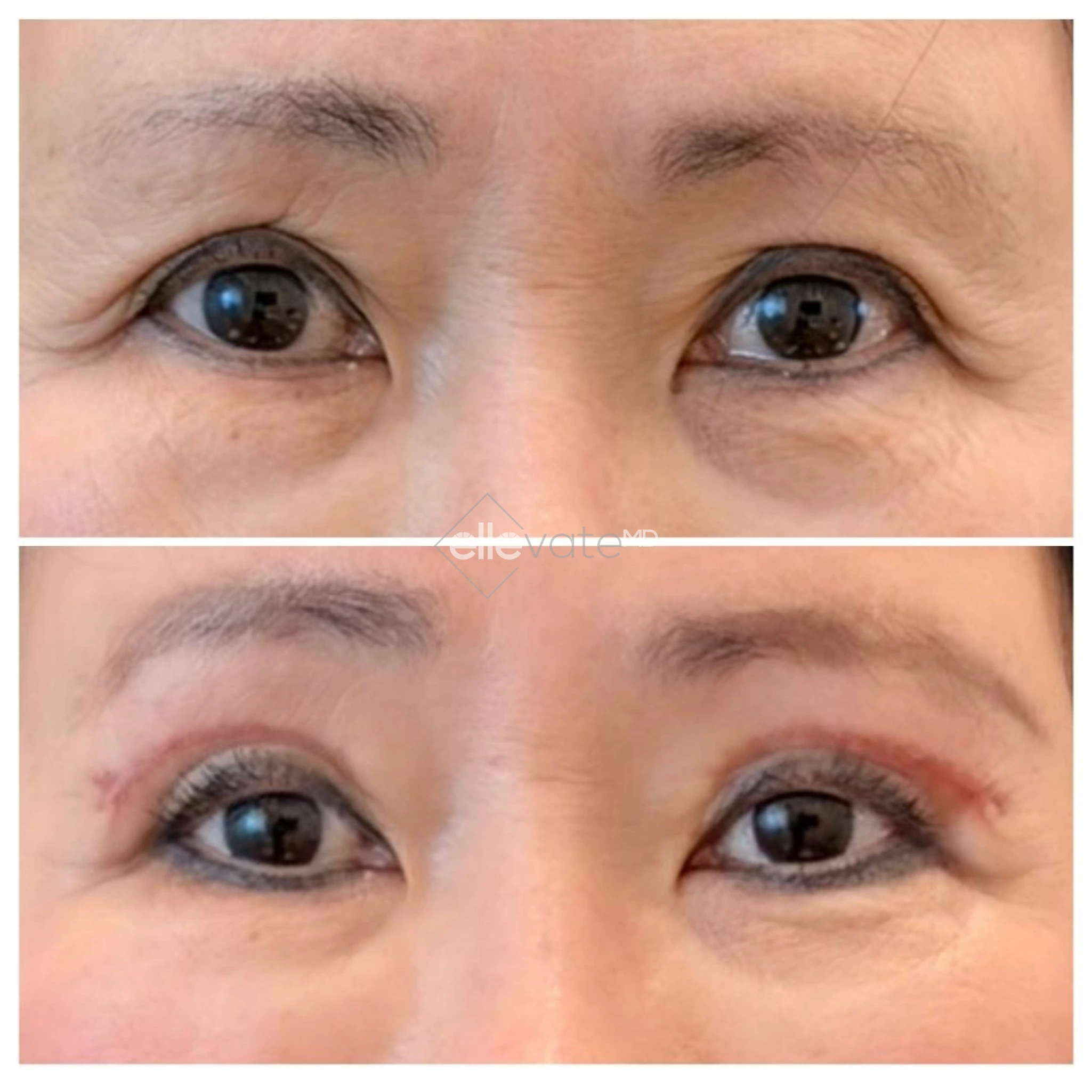 Before and after Signature Lift showing decreased under-eye hollowing and improved eyelid contour