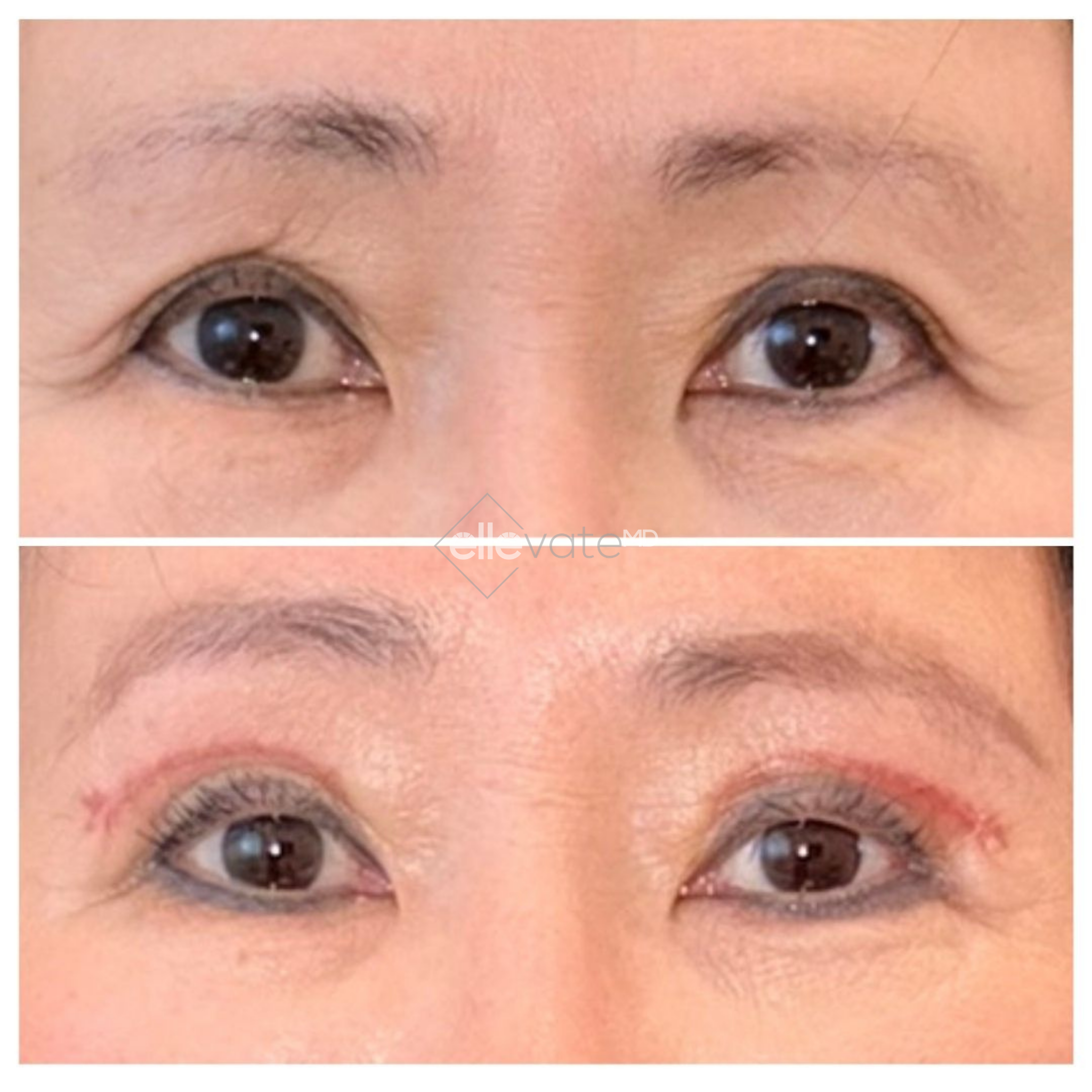 Before and after Signature Lift demonstrating lifted eyelids with reduced sagging and improved eye area definition