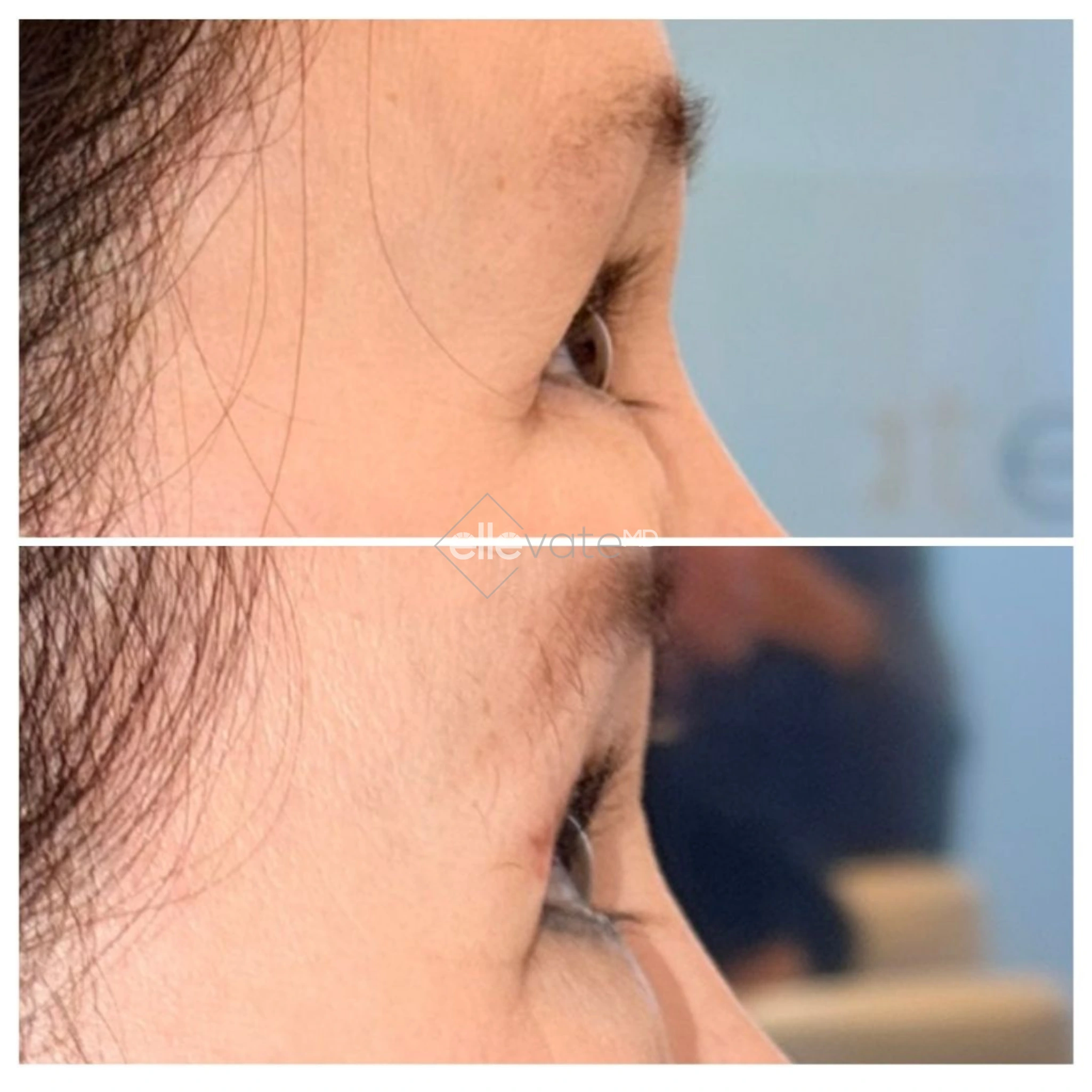 Side profile before and after Signature Lift showing improved cheek projection and eyelid elevation
