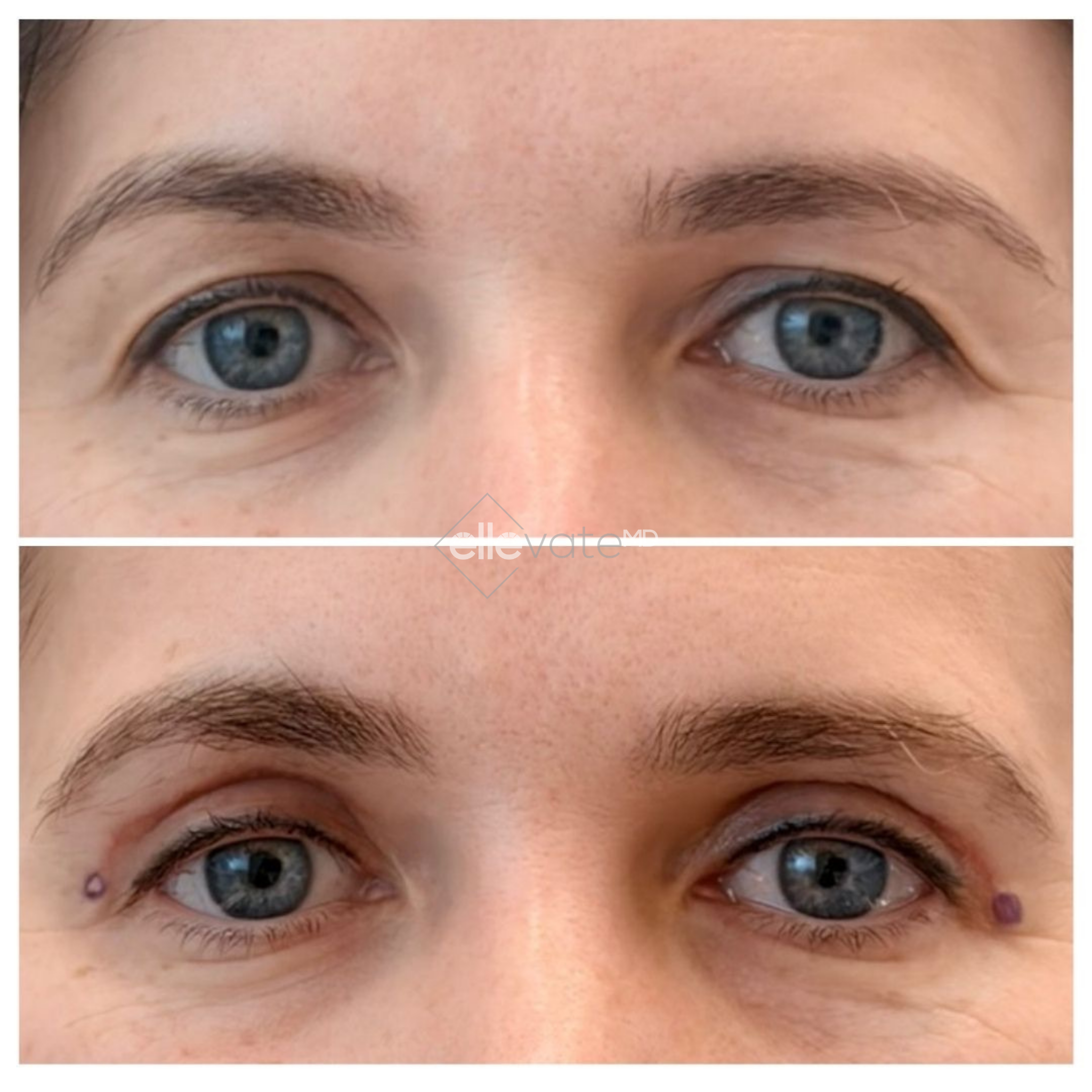 Before and after Signature Lift with treatment markers showing reduced eyelid drooping and lifted eye contours