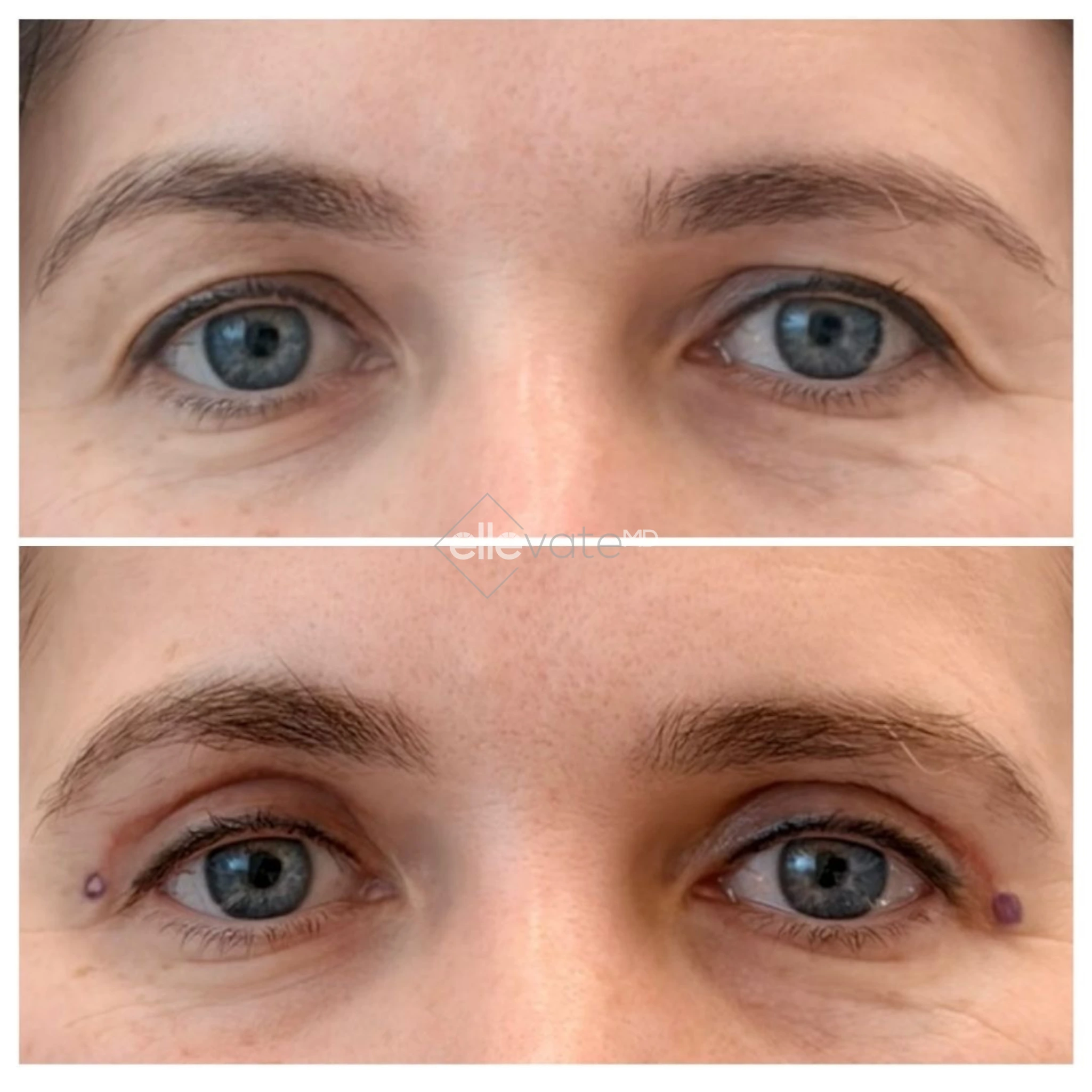 Before and after Signature Lift with treatment markers showing reduced eyelid drooping and lifted eye contours