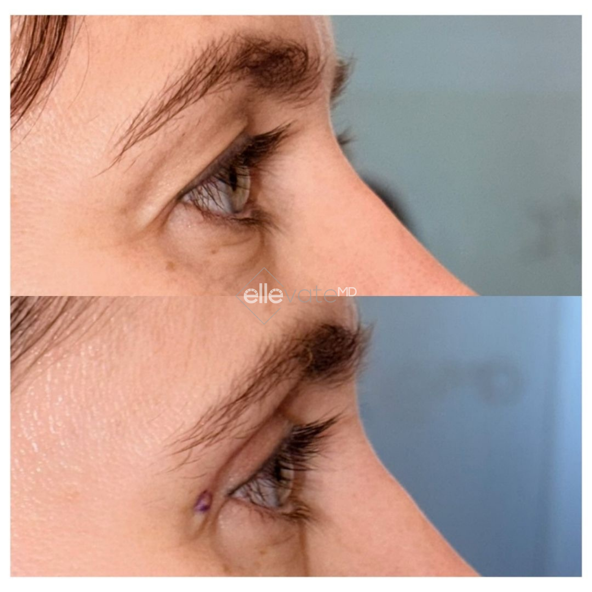 Side profile before and after Signature Lift with marker showing improved facial contours and eyelid support