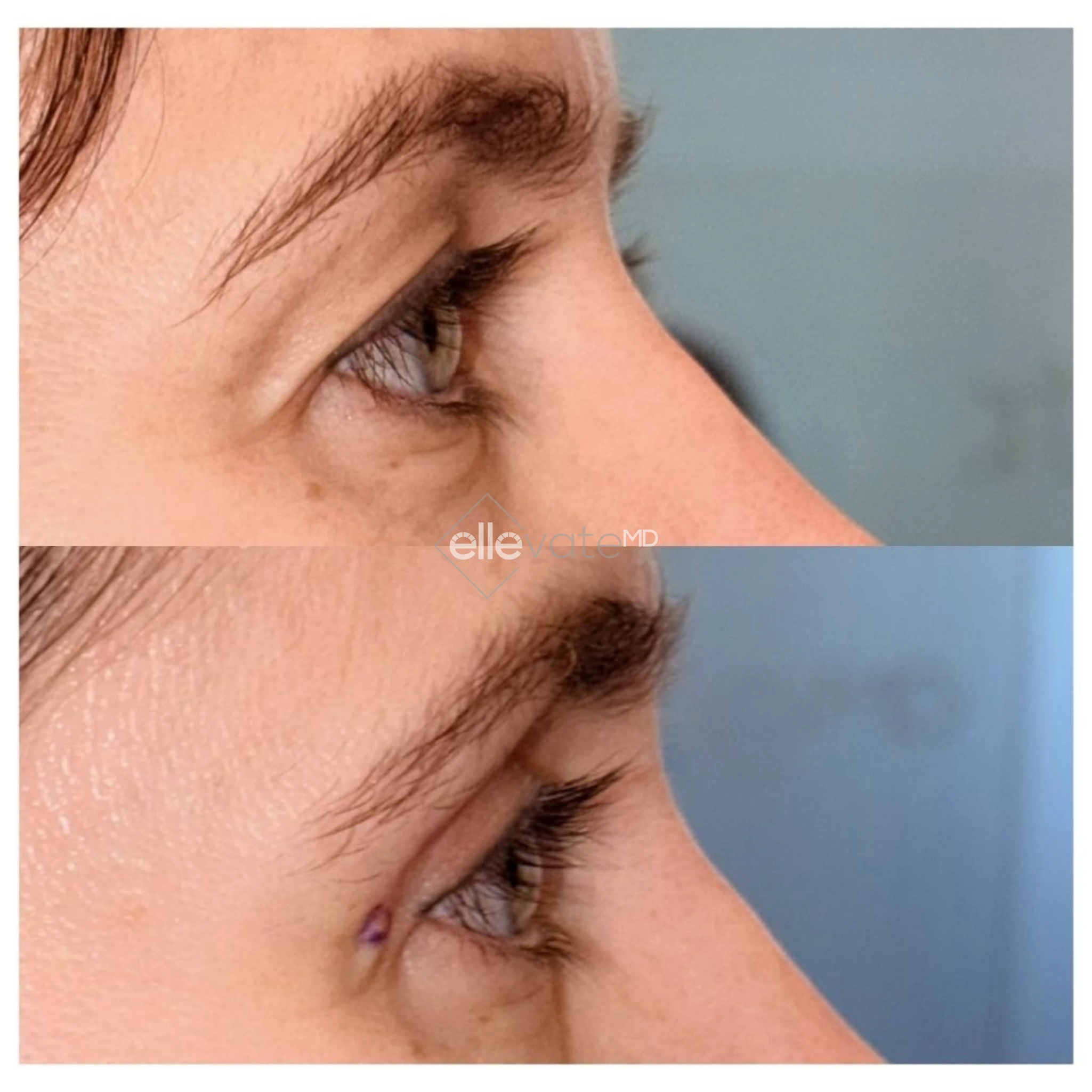 Side profile before and after Signature Lift with marker showing improved facial contours and eyelid support