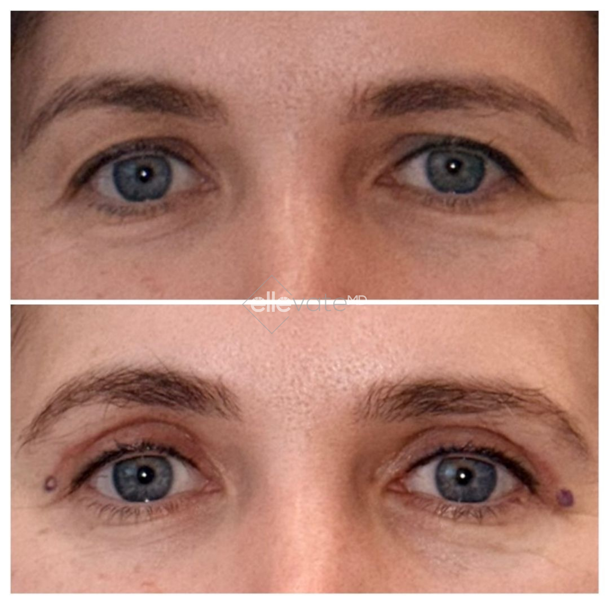 Before and after comparison of eyes showing reduced under-eye hollowing and lifted appearance