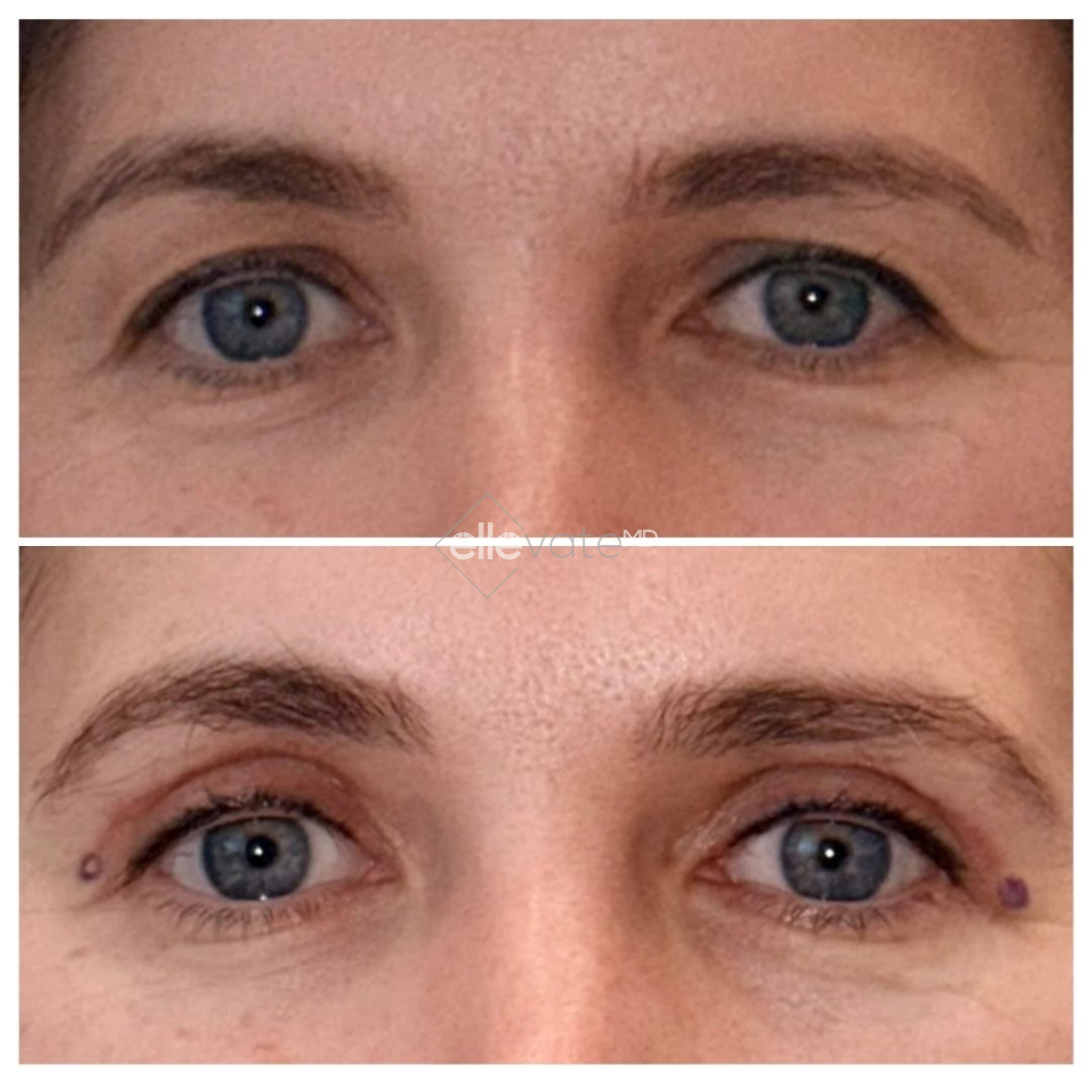 Before and after comparison of eyes showing reduced under-eye hollowing and lifted appearance