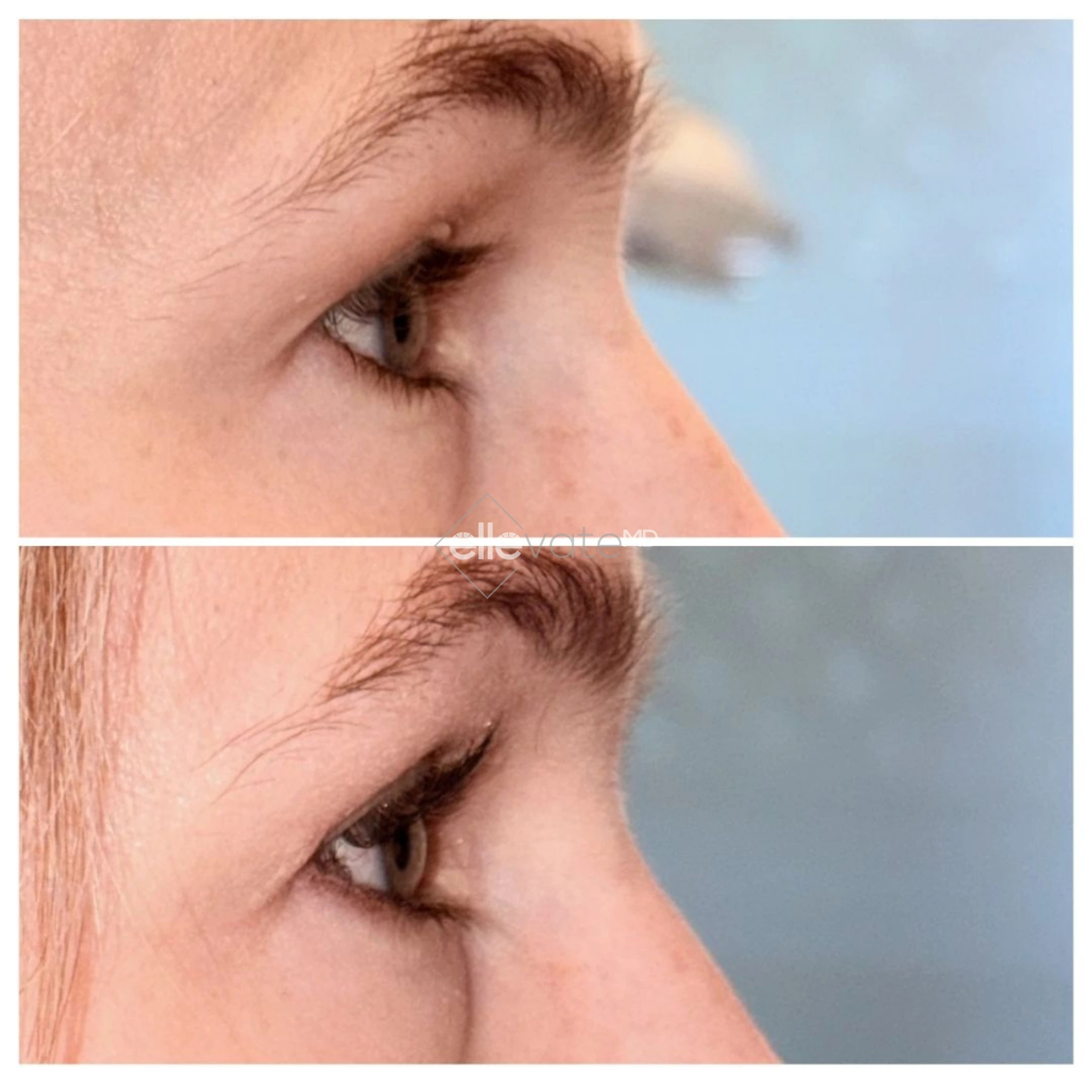 Side profile before and after comparison showing improved eye area definition and lift