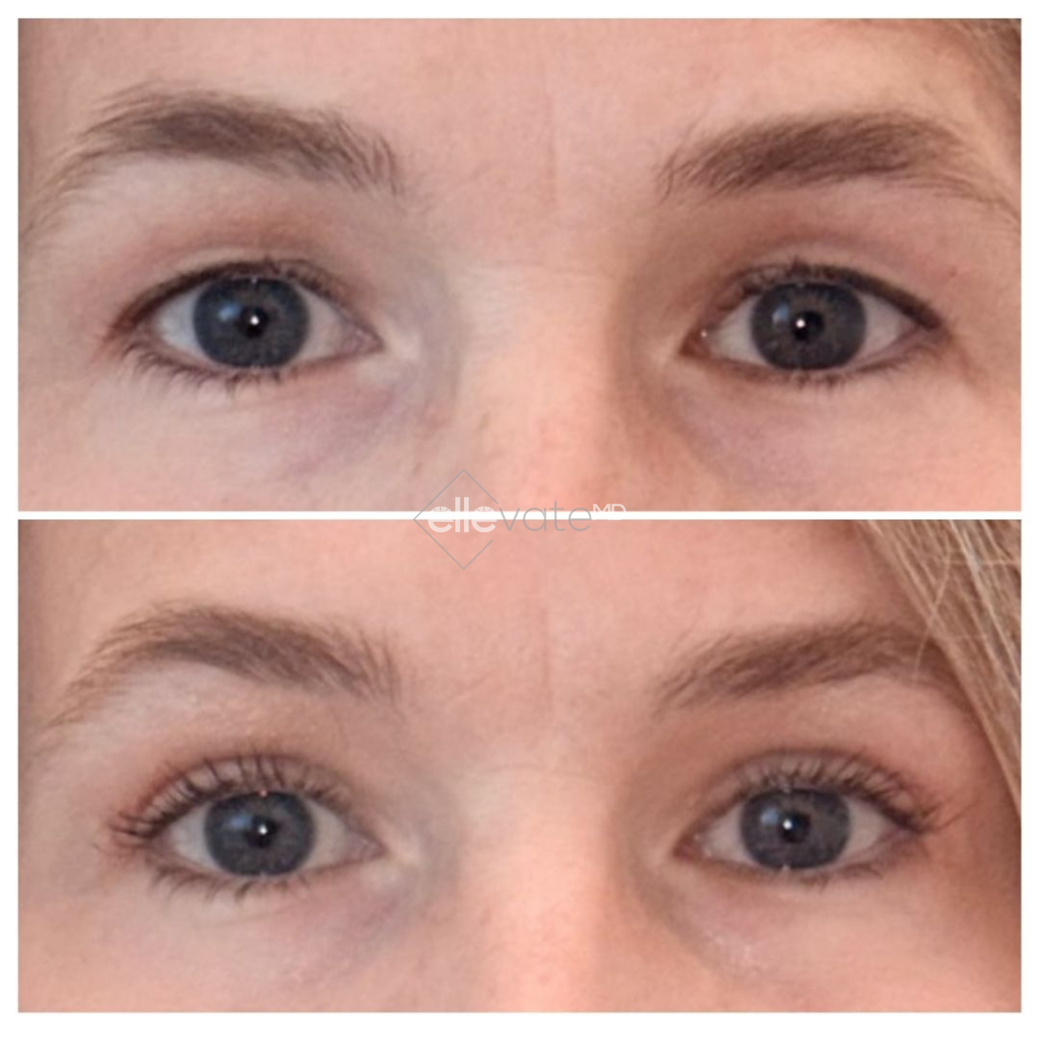 Before and after frontal eye comparison showing enhanced lash line and reduced under-eye bags