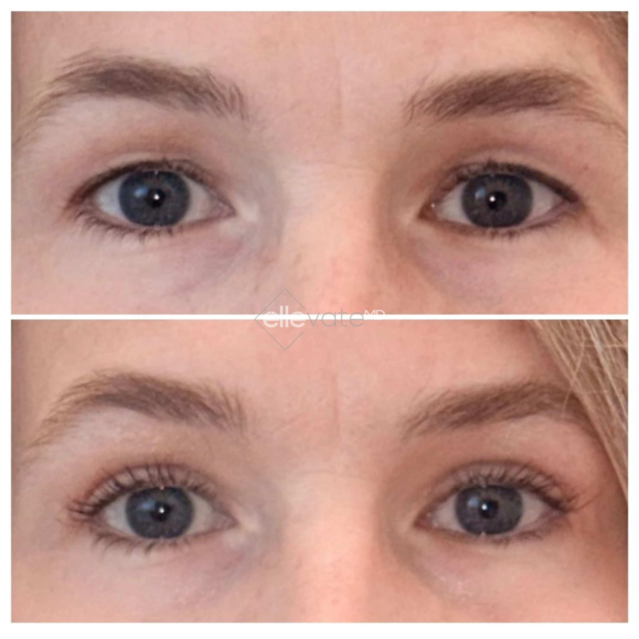 Before and after frontal eye comparison showing enhanced lash line and reduced under-eye bags