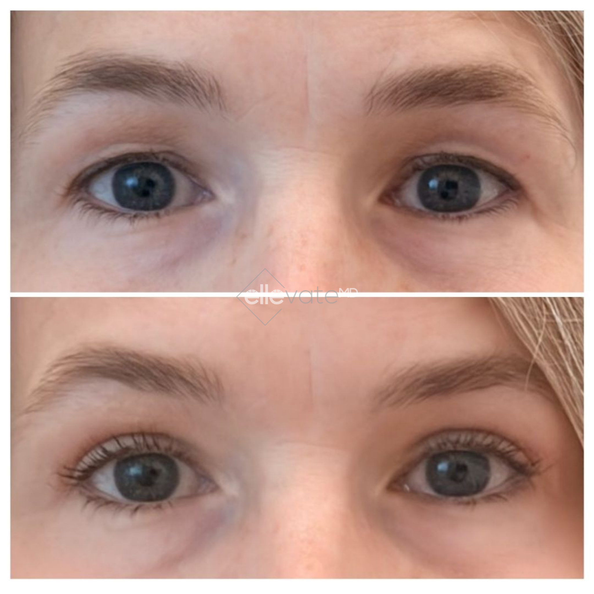 Before and after frontal eye comparison showing lifted appearance and improved eye contour