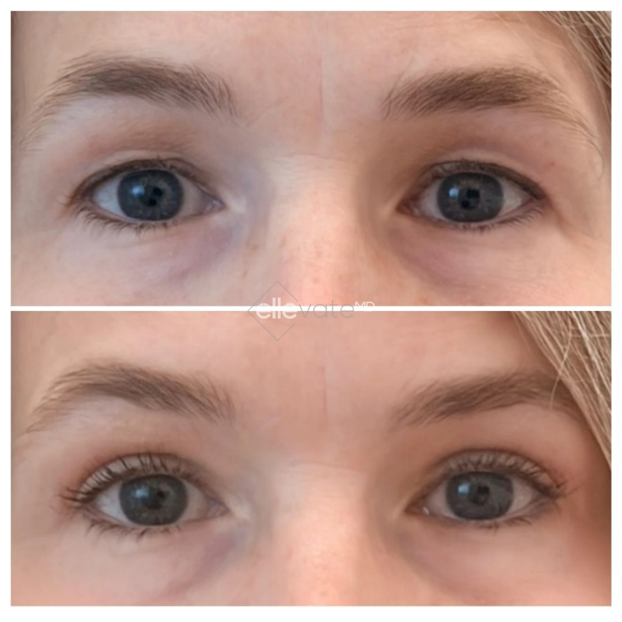 Before and after frontal eye comparison showing lifted appearance and improved eye contour