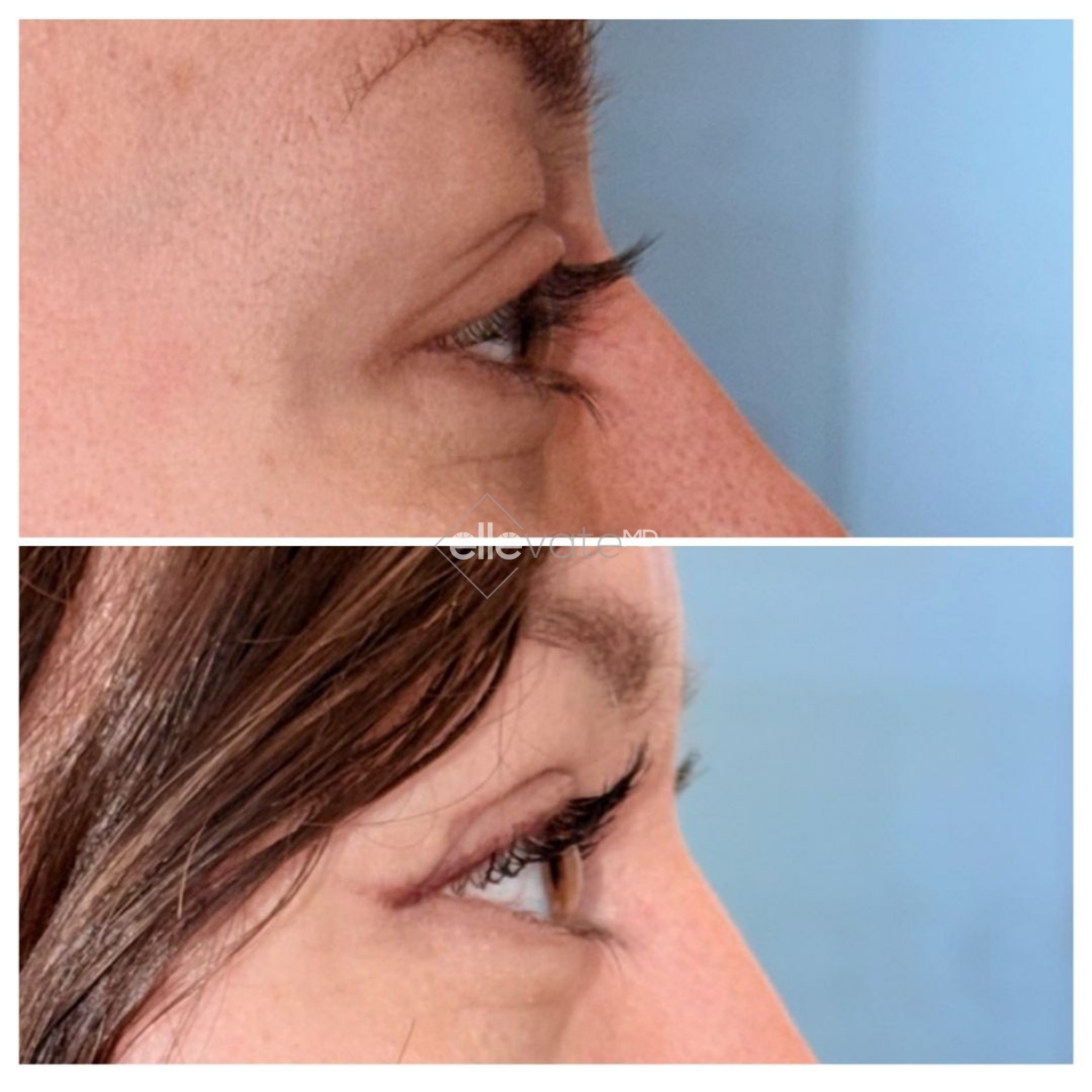 Side profile before and after comparison showing improved eye and cheek area definition