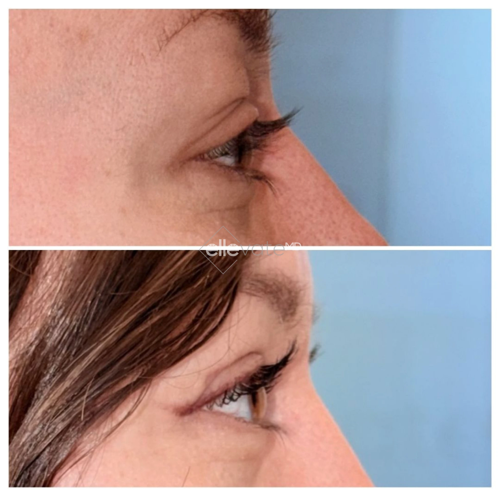 Side profile before and after comparison showing improved eye and cheek area definition