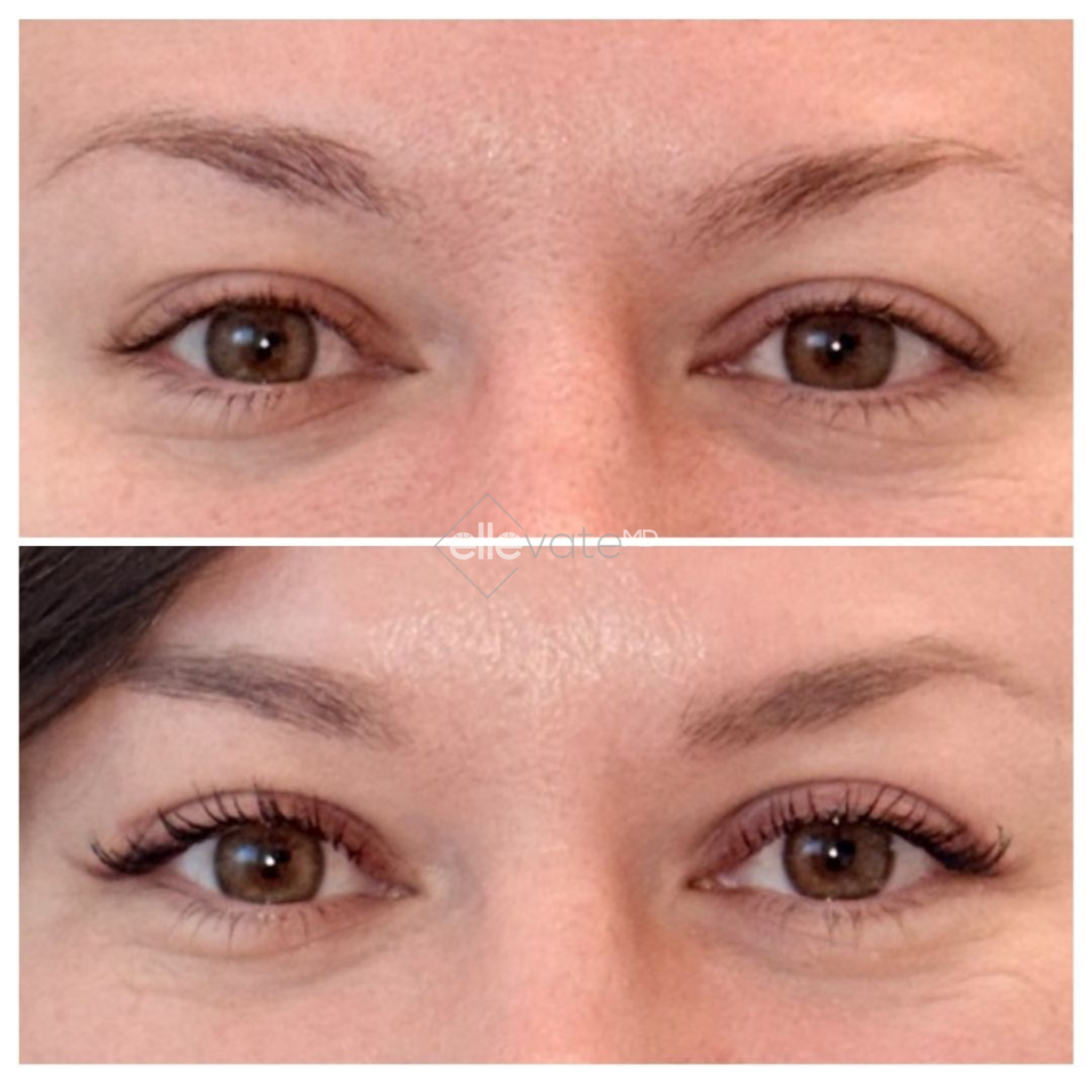 Before and after frontal eye comparison showing enhanced eyelid definition and reduced puffiness