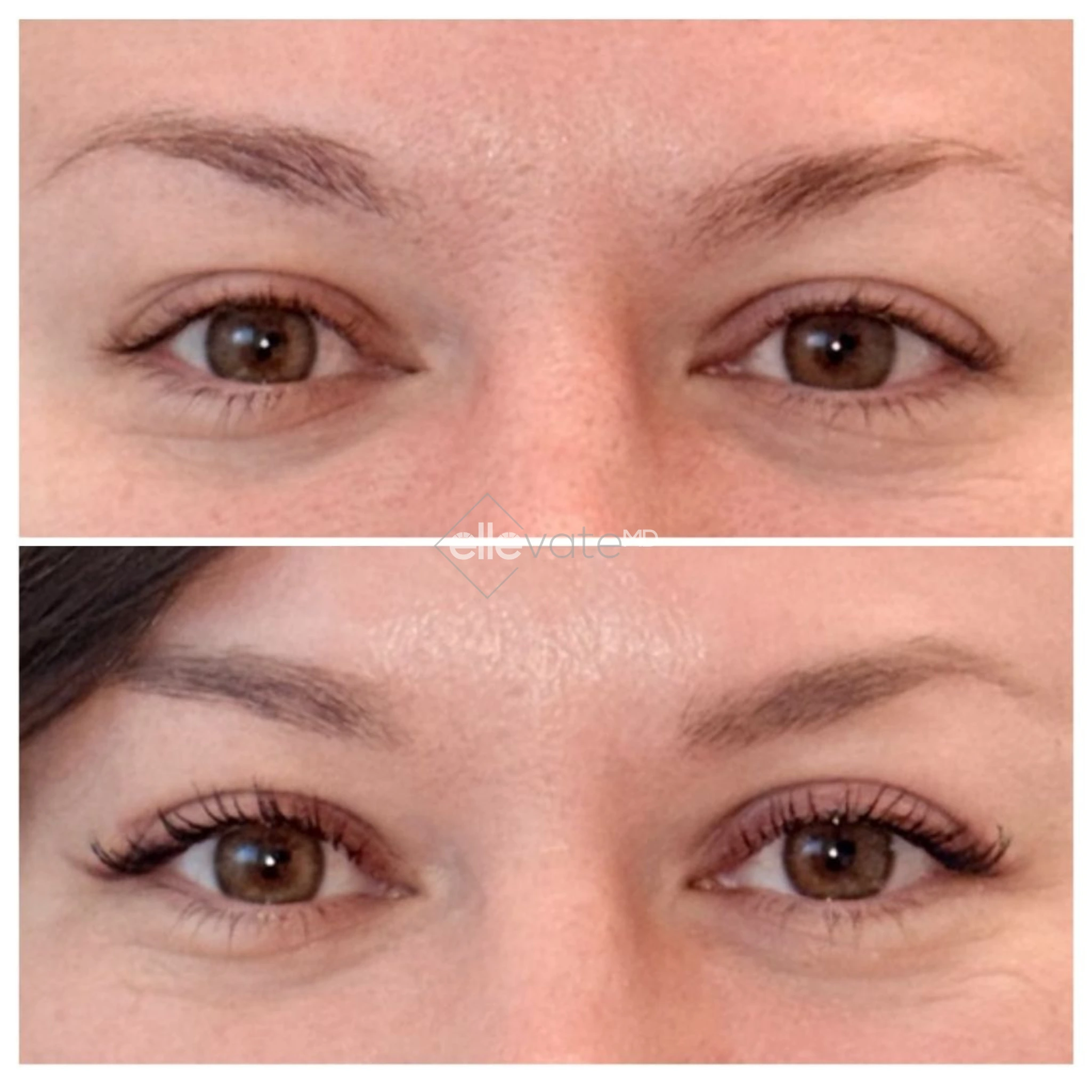 Before and after frontal eye comparison showing enhanced eyelid definition and reduced puffiness