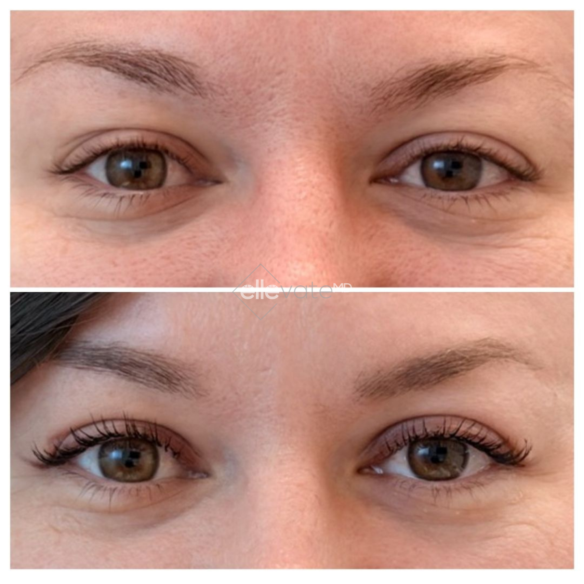 Before and after comparison of eyes with reduced under-eye hollowing and improved eyelid lift