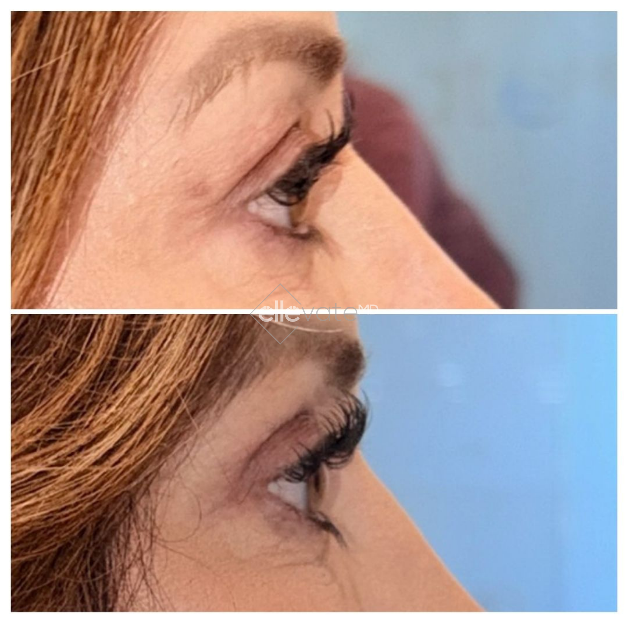 Side profile before and after showing improved cheekbone definition and lifted facial contours