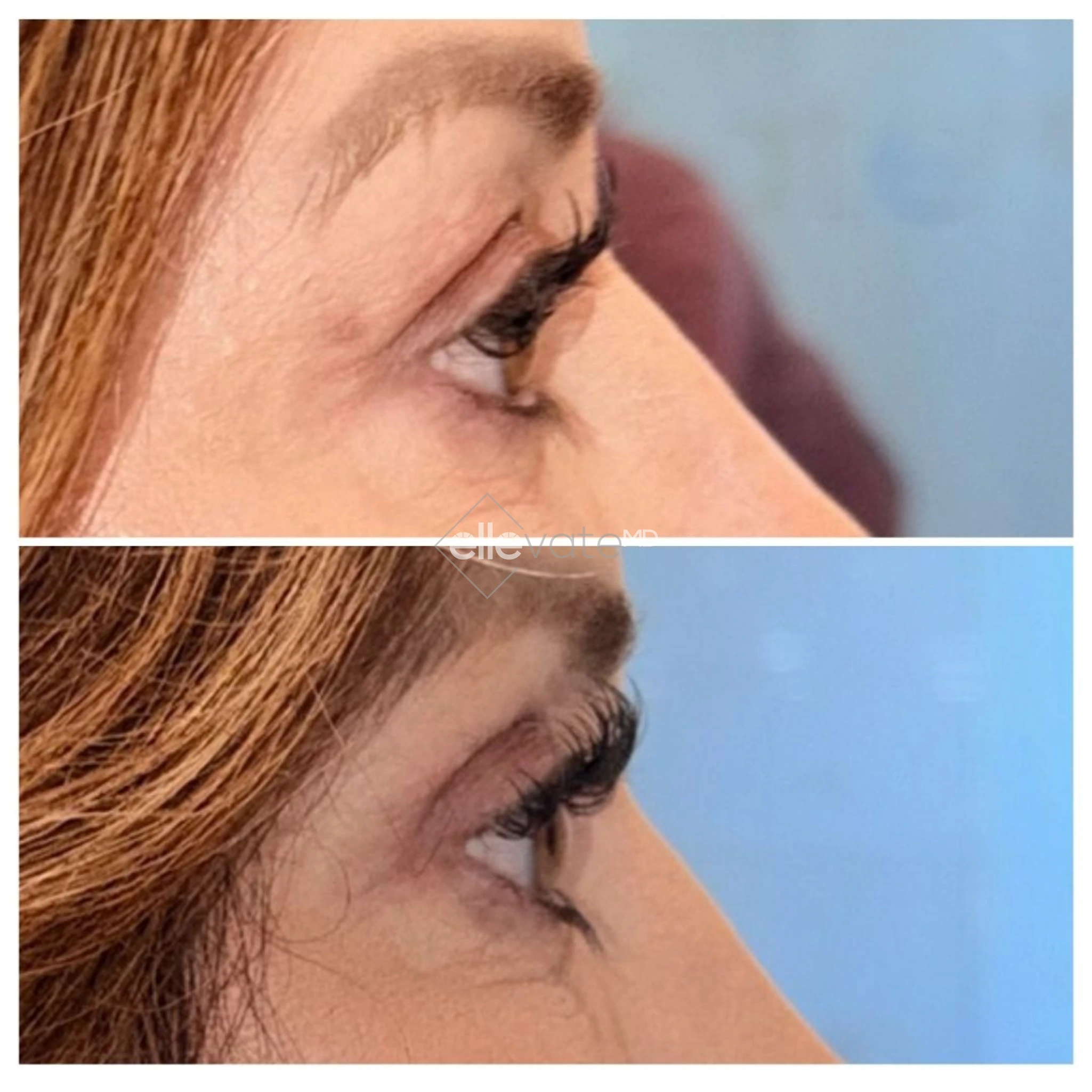 Side profile before and after showing improved cheekbone definition and lifted facial contours