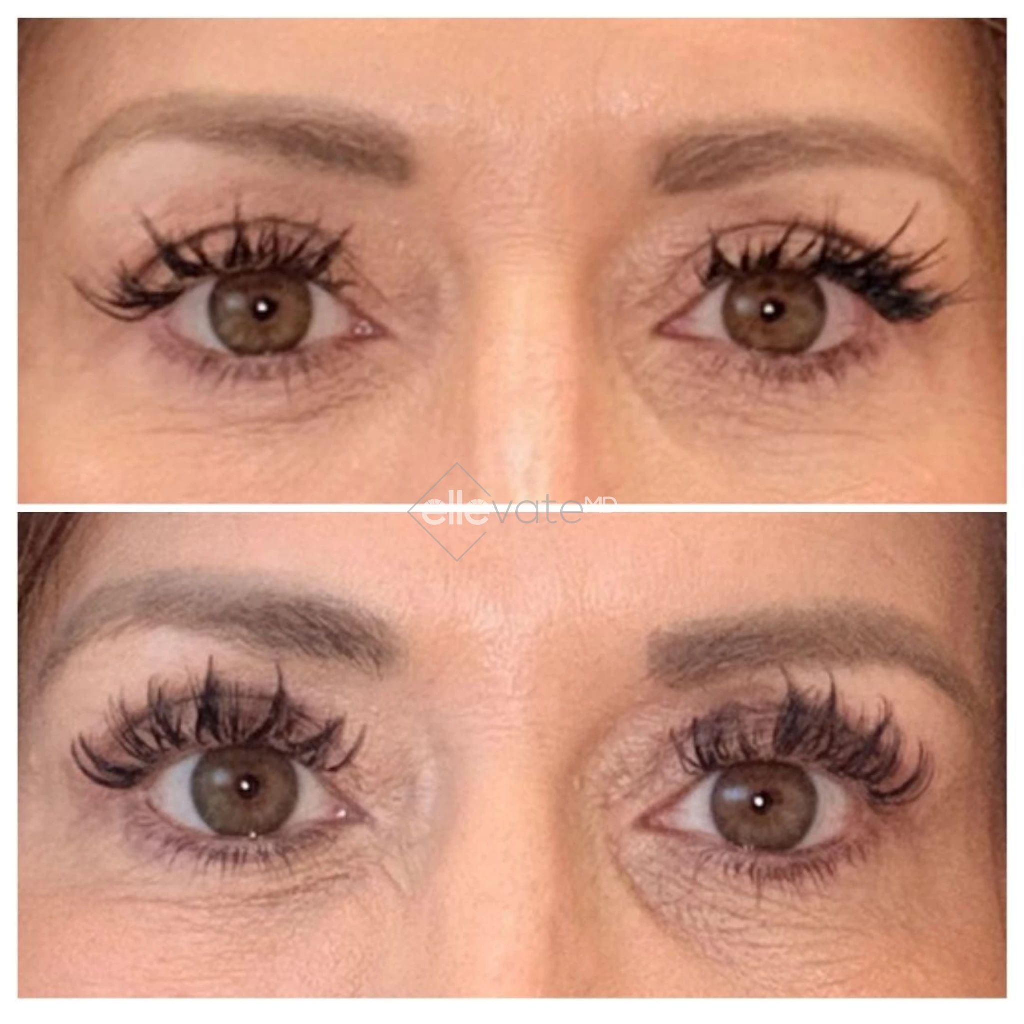 Before and after front-facing eye comparison showing lifted lids and reduced under-eye sagging