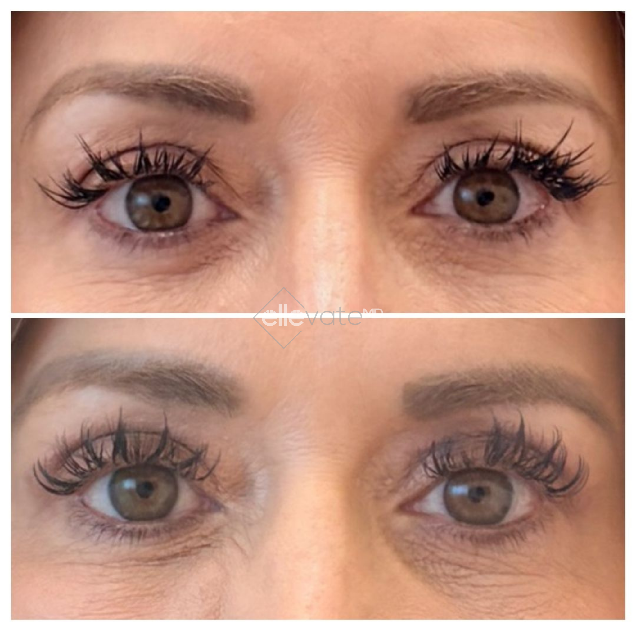 Before and after direct eye comparison demonstrating lifted eyelids and improved eye opening
