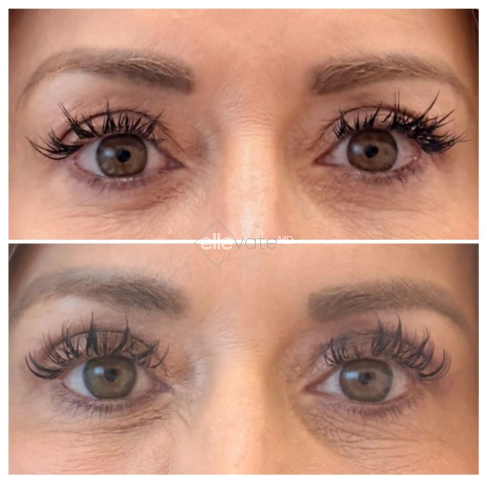 Before and after direct eye comparison demonstrating lifted eyelids and improved eye opening